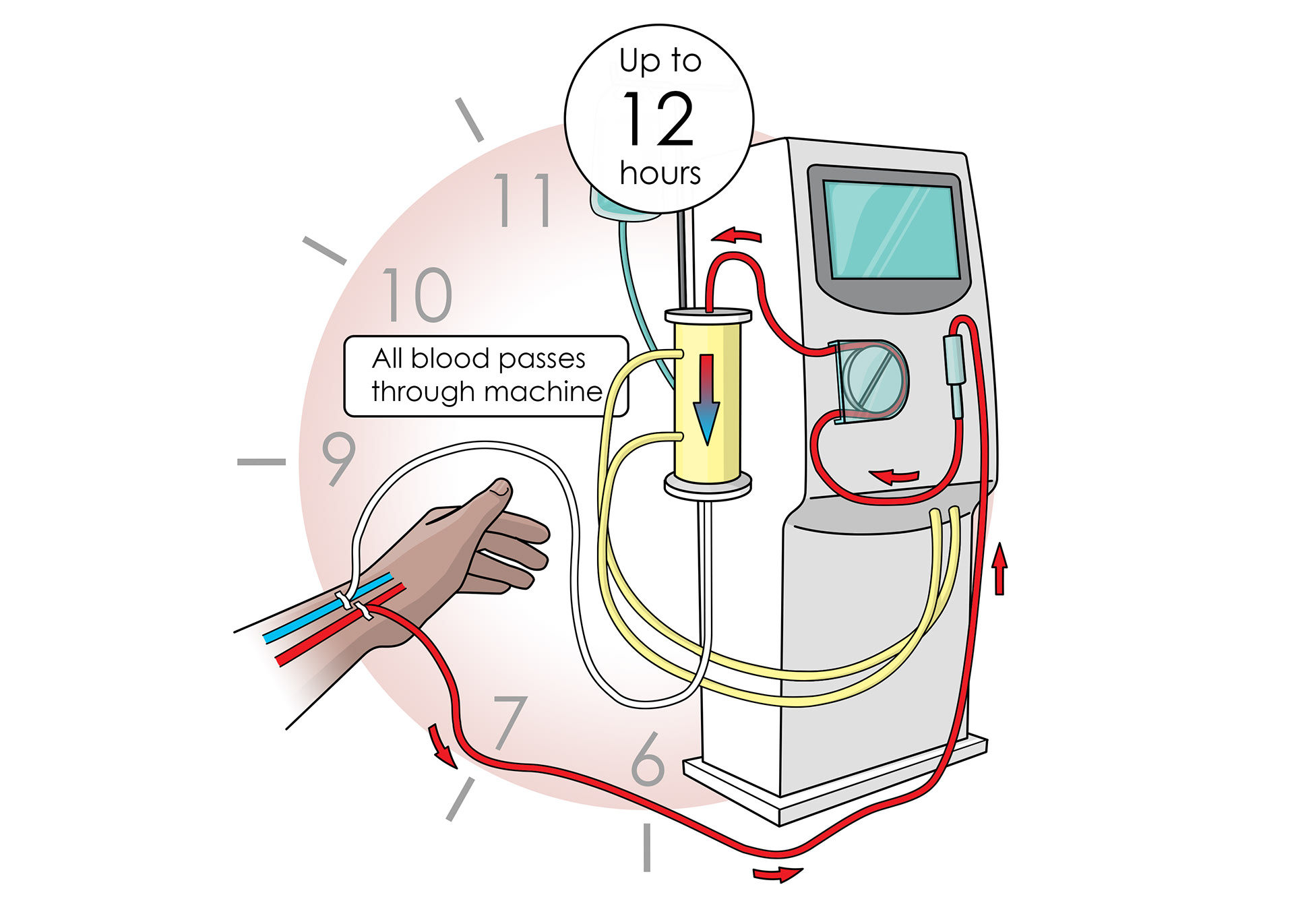 All blood passes through the machine for up to 12 hours