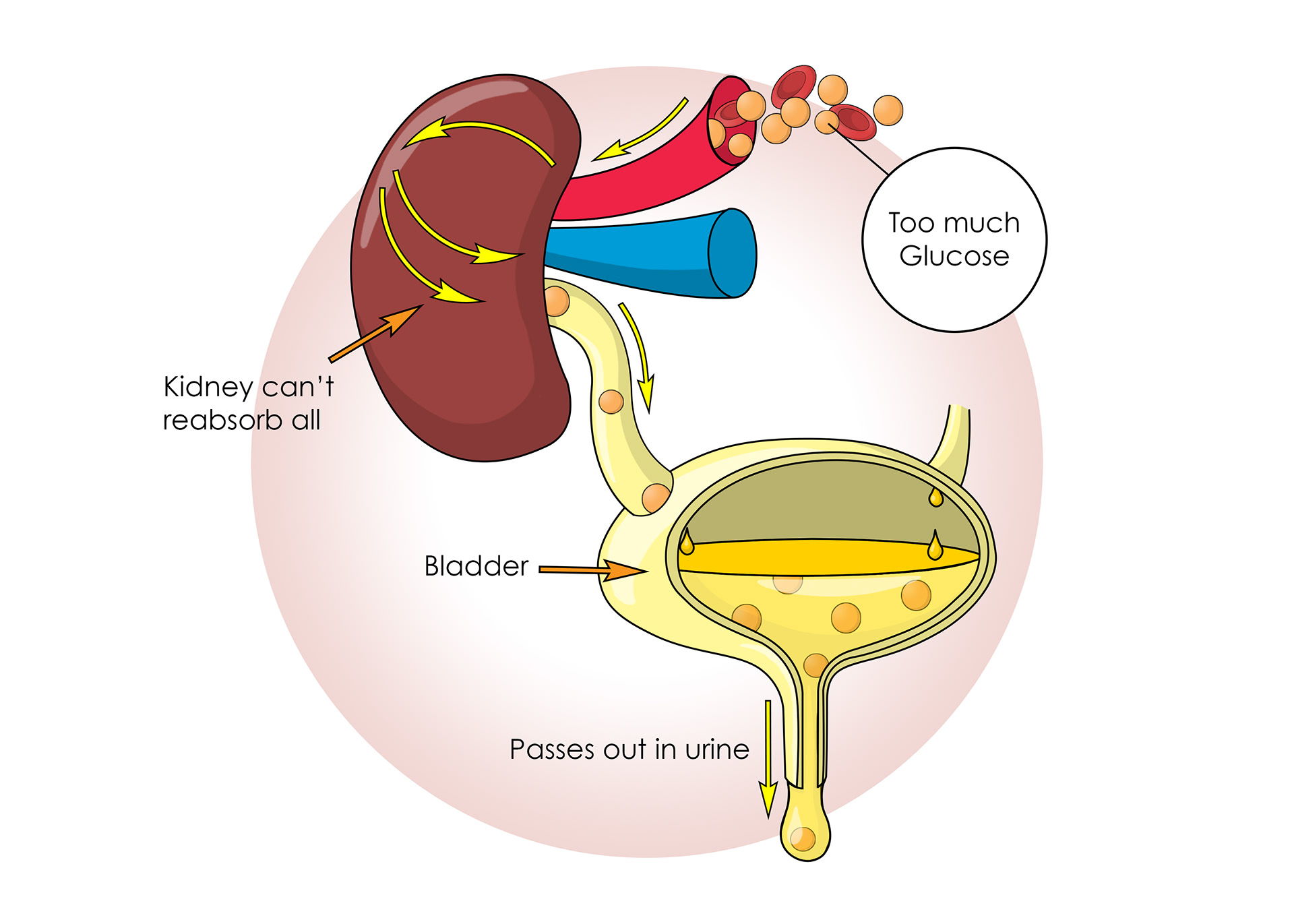 Too much glucose for the body to reabsorb can end up in urine