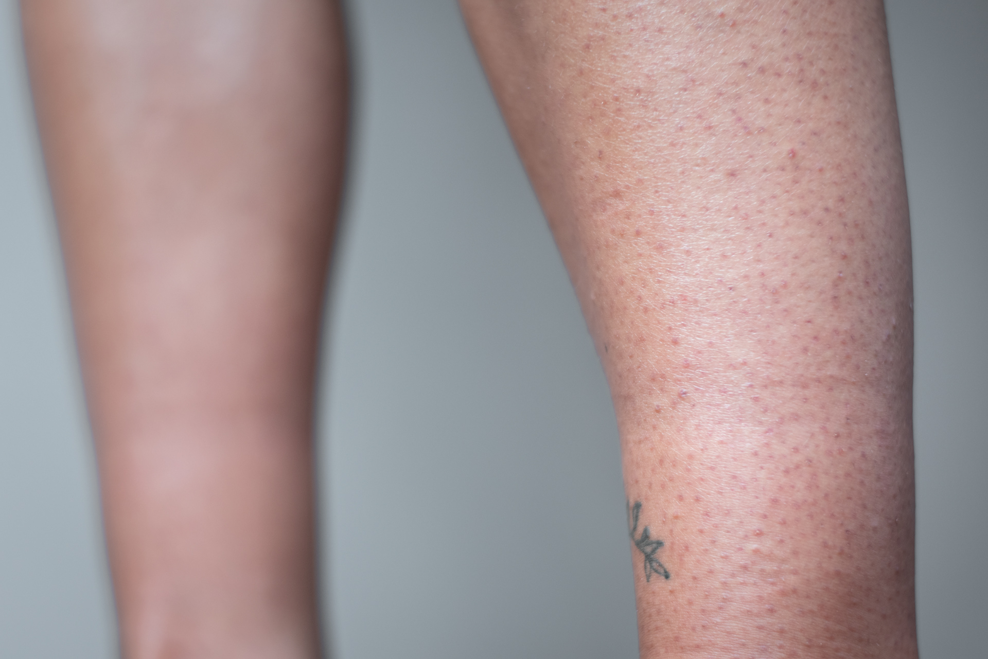 Folliculitis
