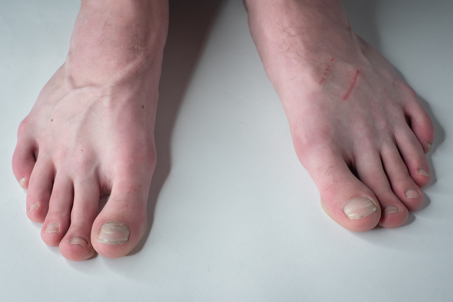 Big, ugly toes