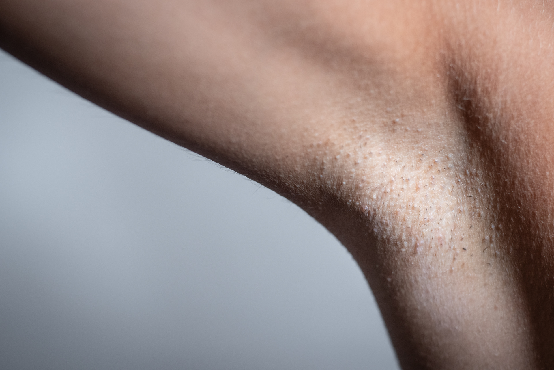 Ingrown hairs