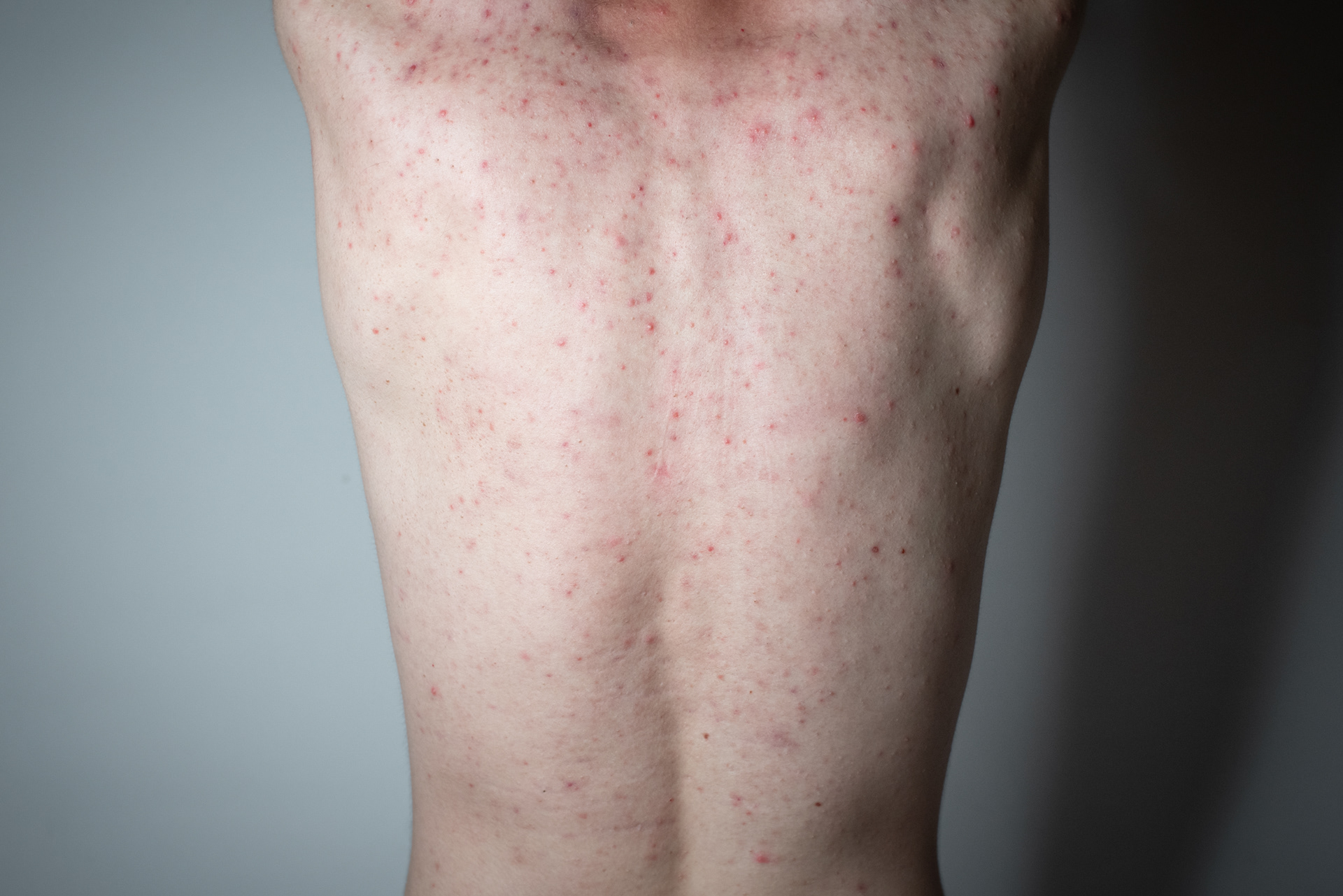 Zits