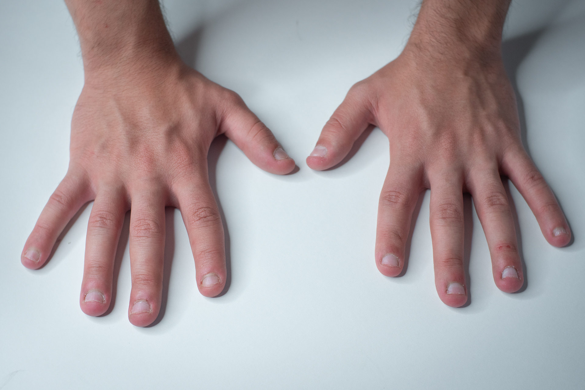 Bitten nails