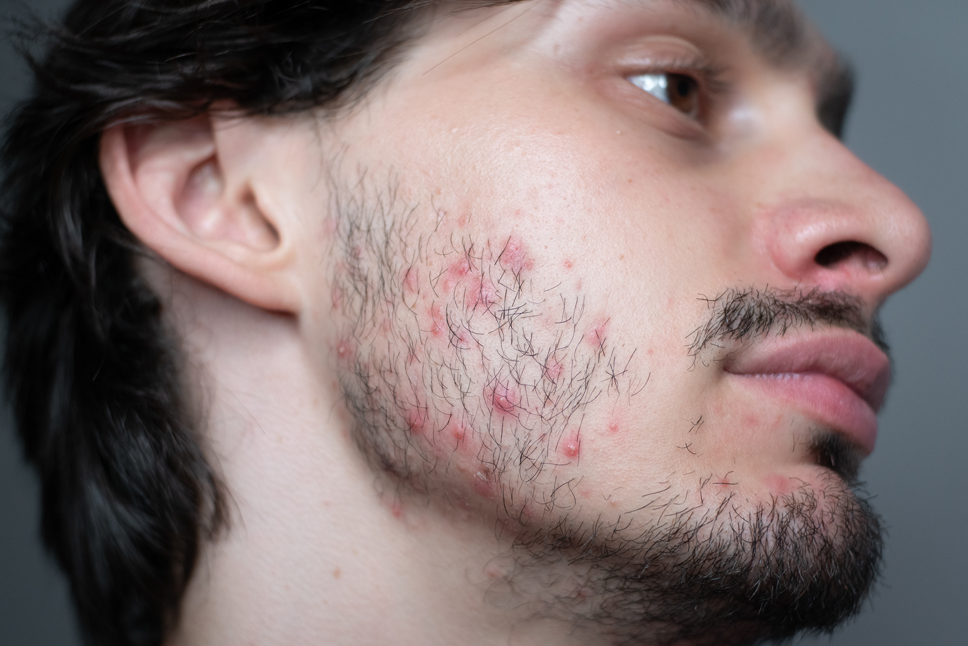 Zits