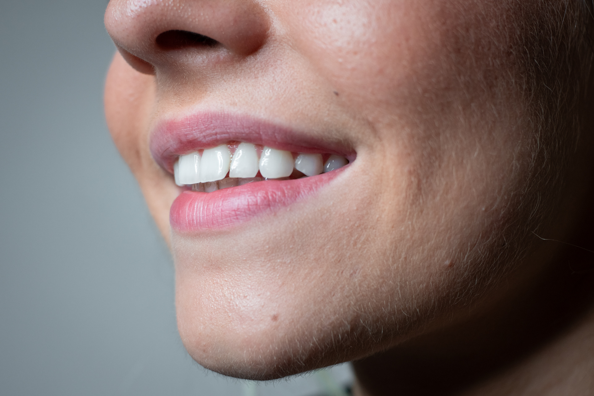 Crooked tooth