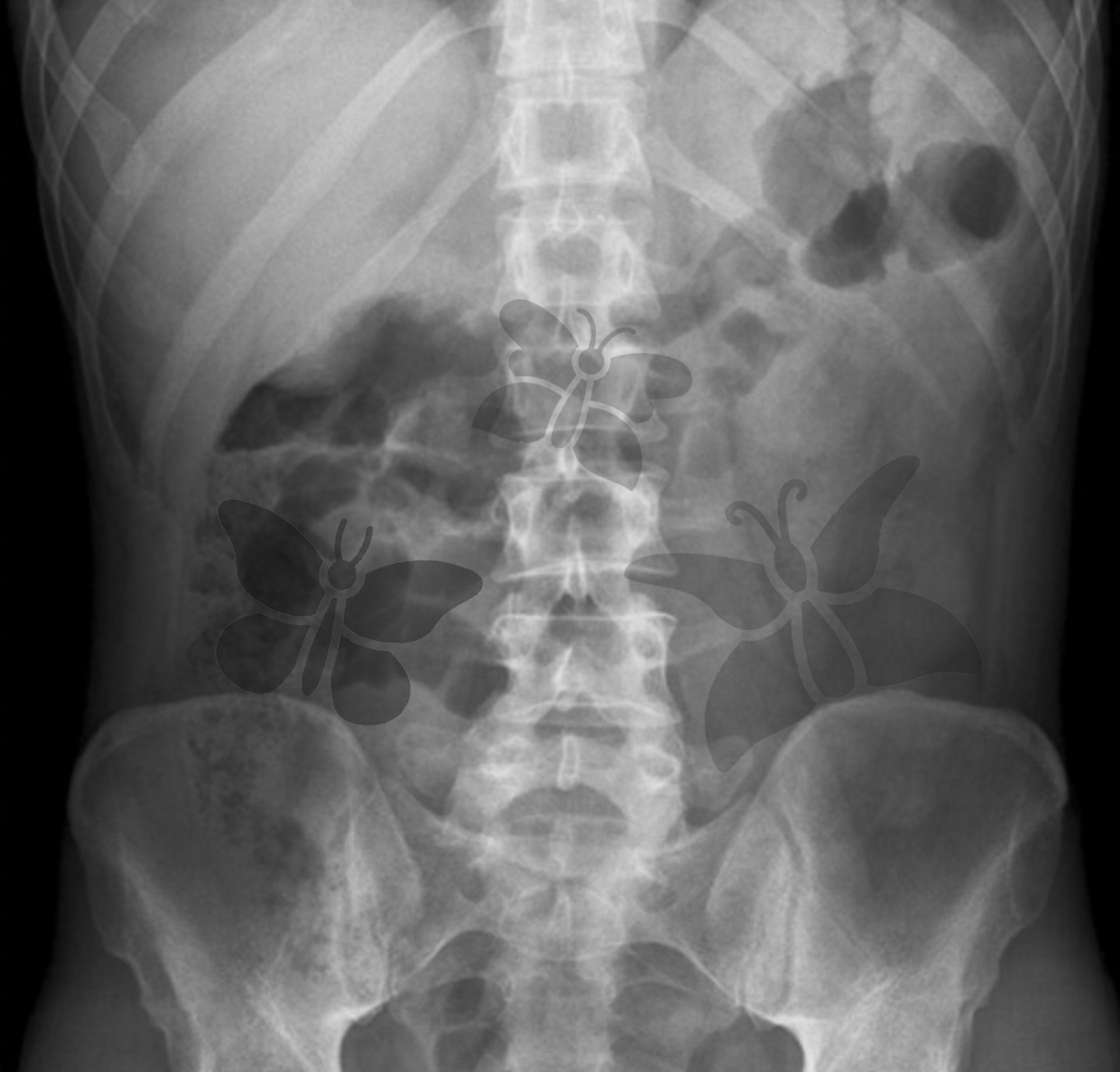 1. Schmetterlinge im Bauch