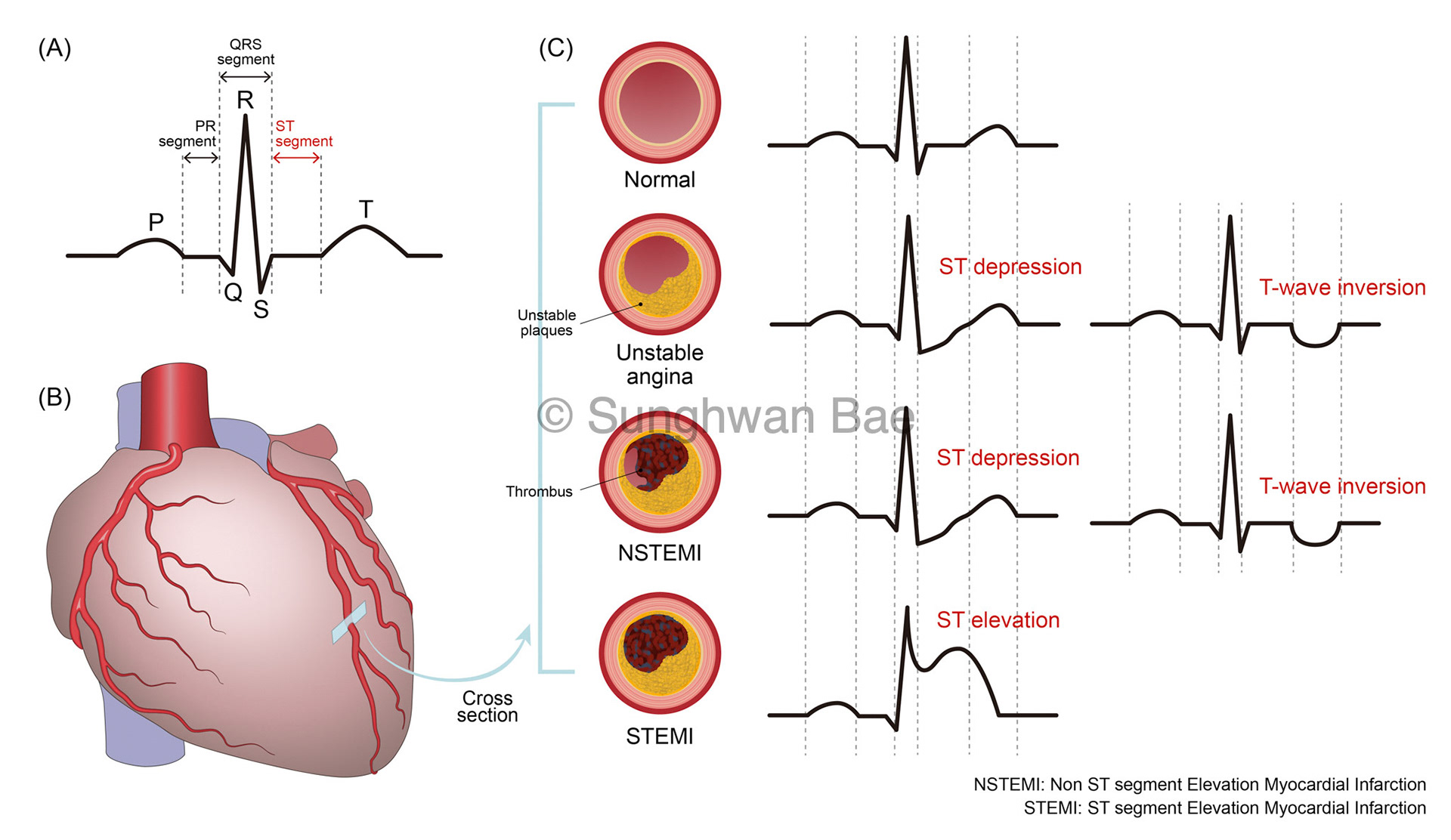 Different types of myocardial infarctions and their ECG pattern.