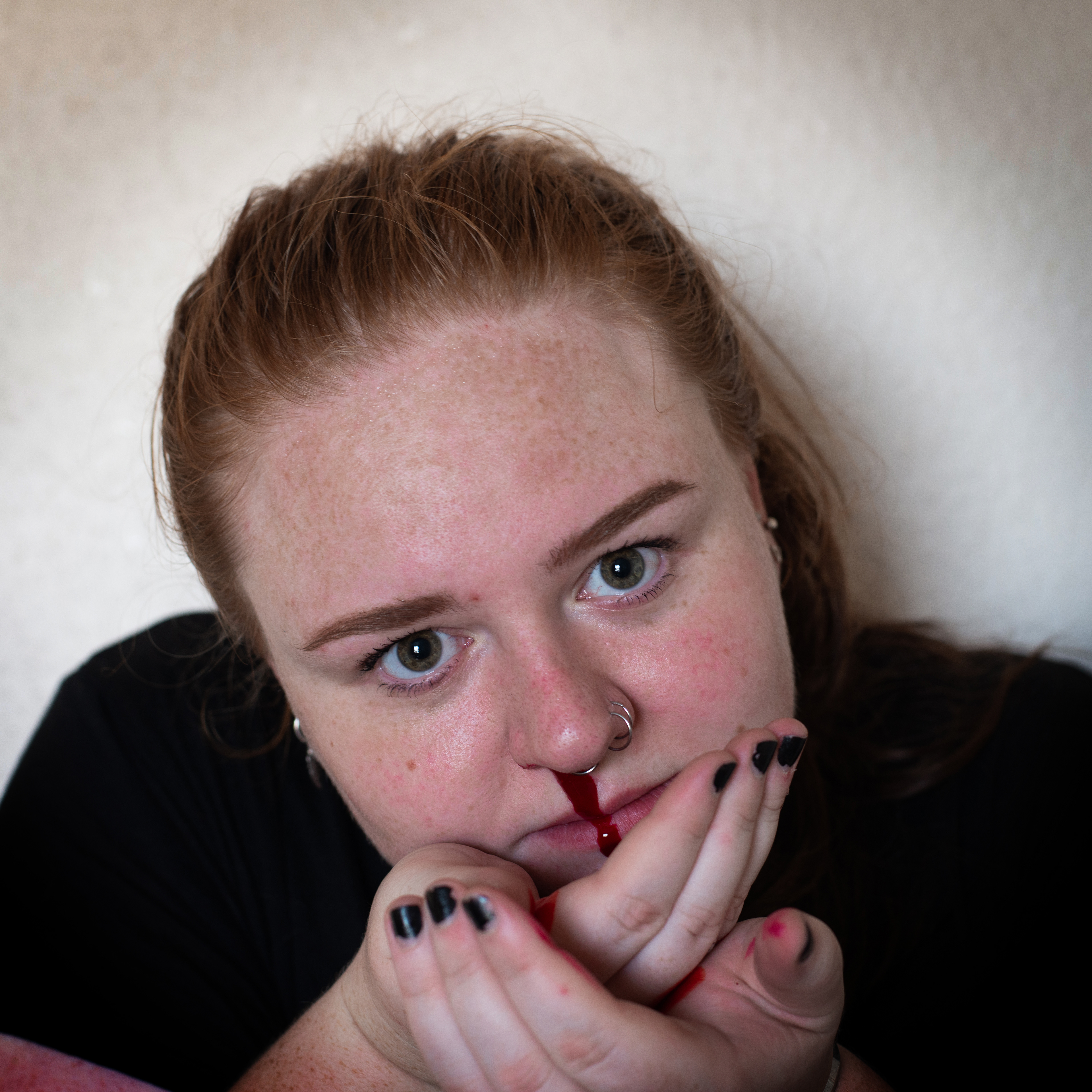 epistaxiophobia: the fear of nosebleeds