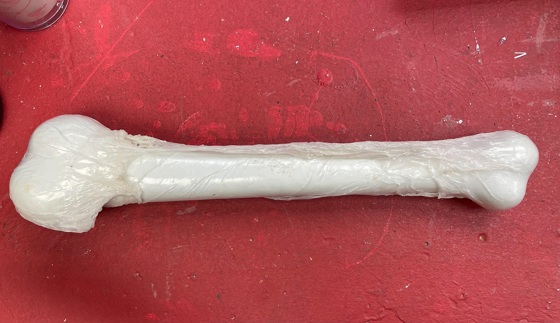 Plastic melted around bone
