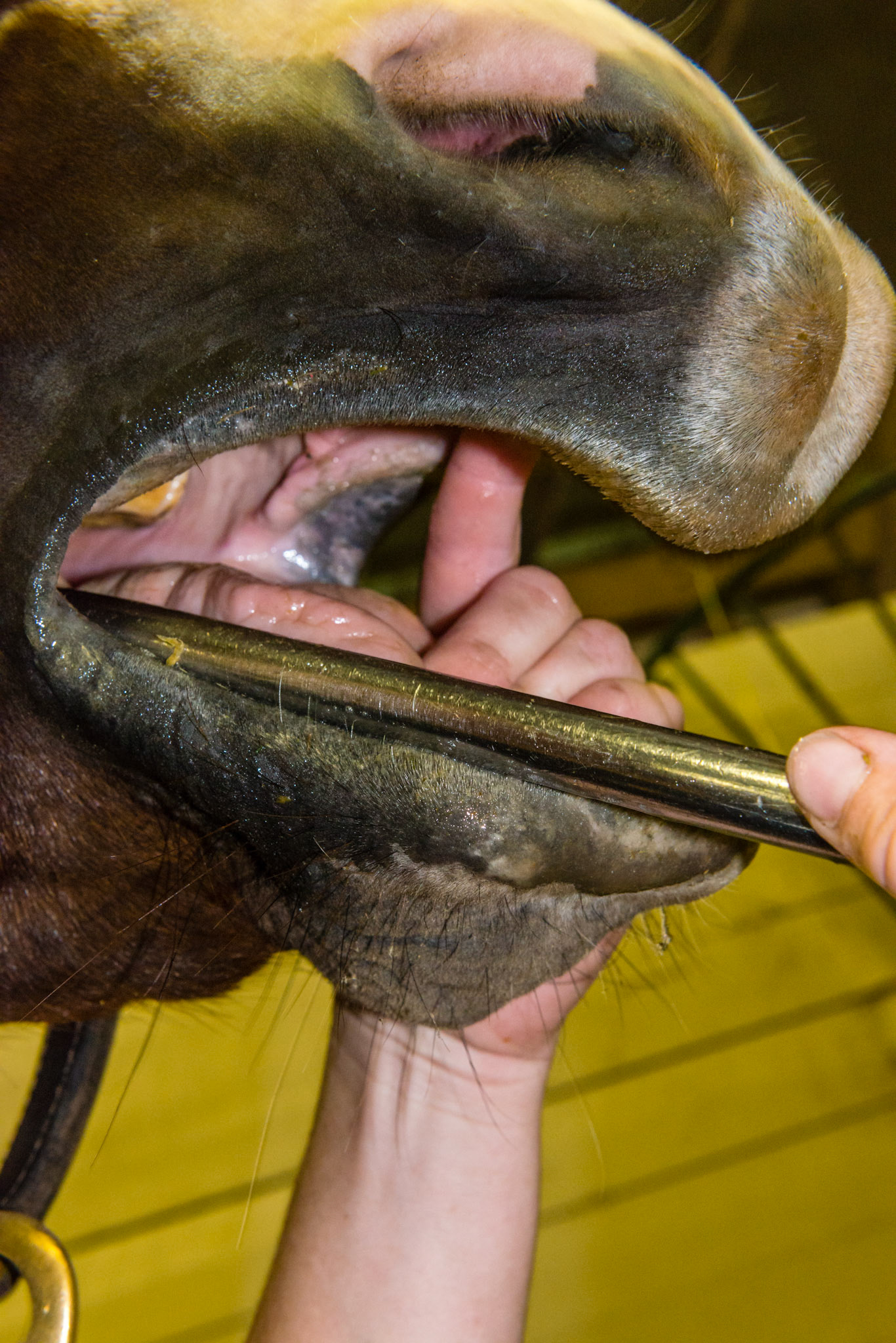 Tongue trapper and palate poker are combined in this picture.