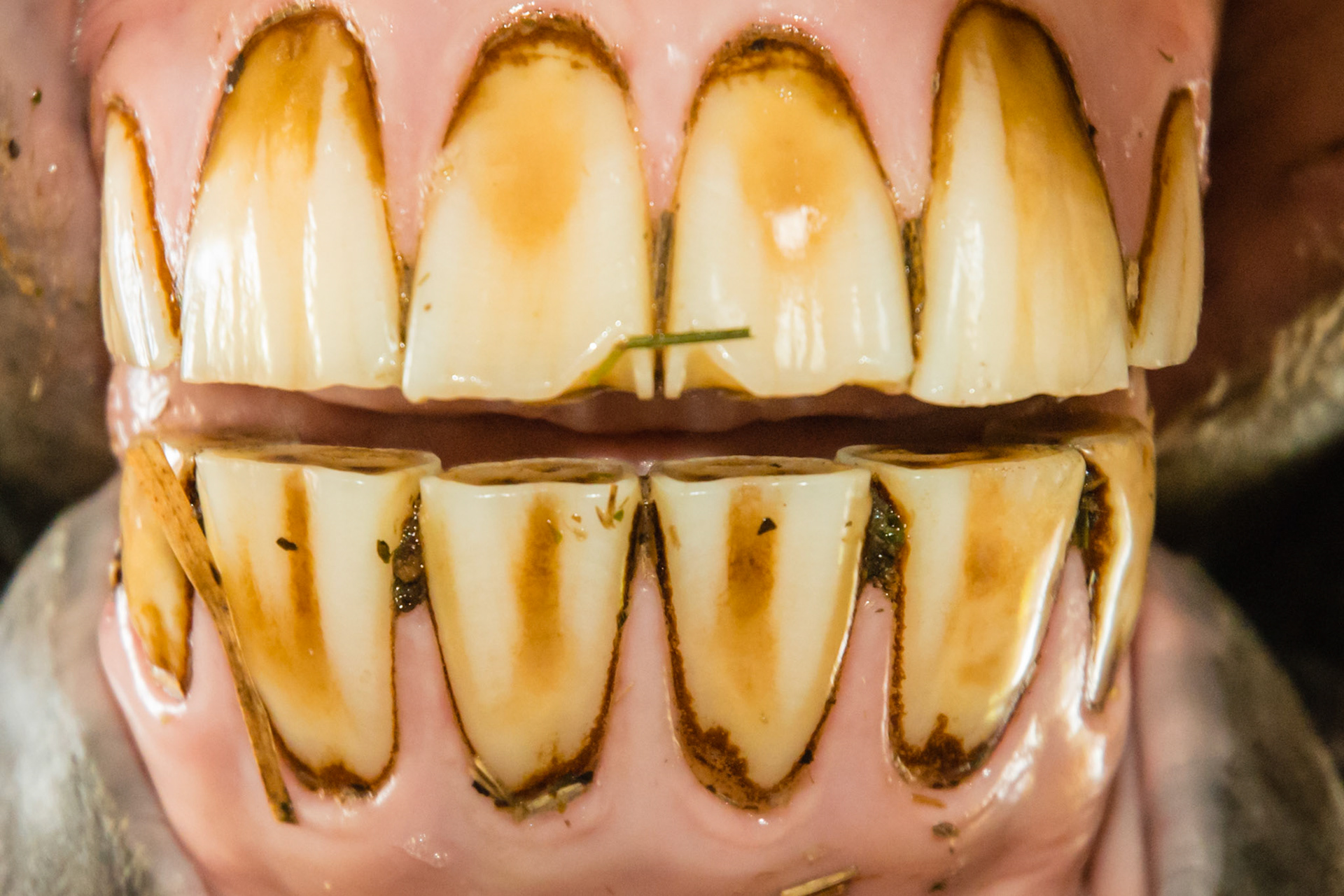 13yr 3mo - incisor cap remnants next to 203 and 403