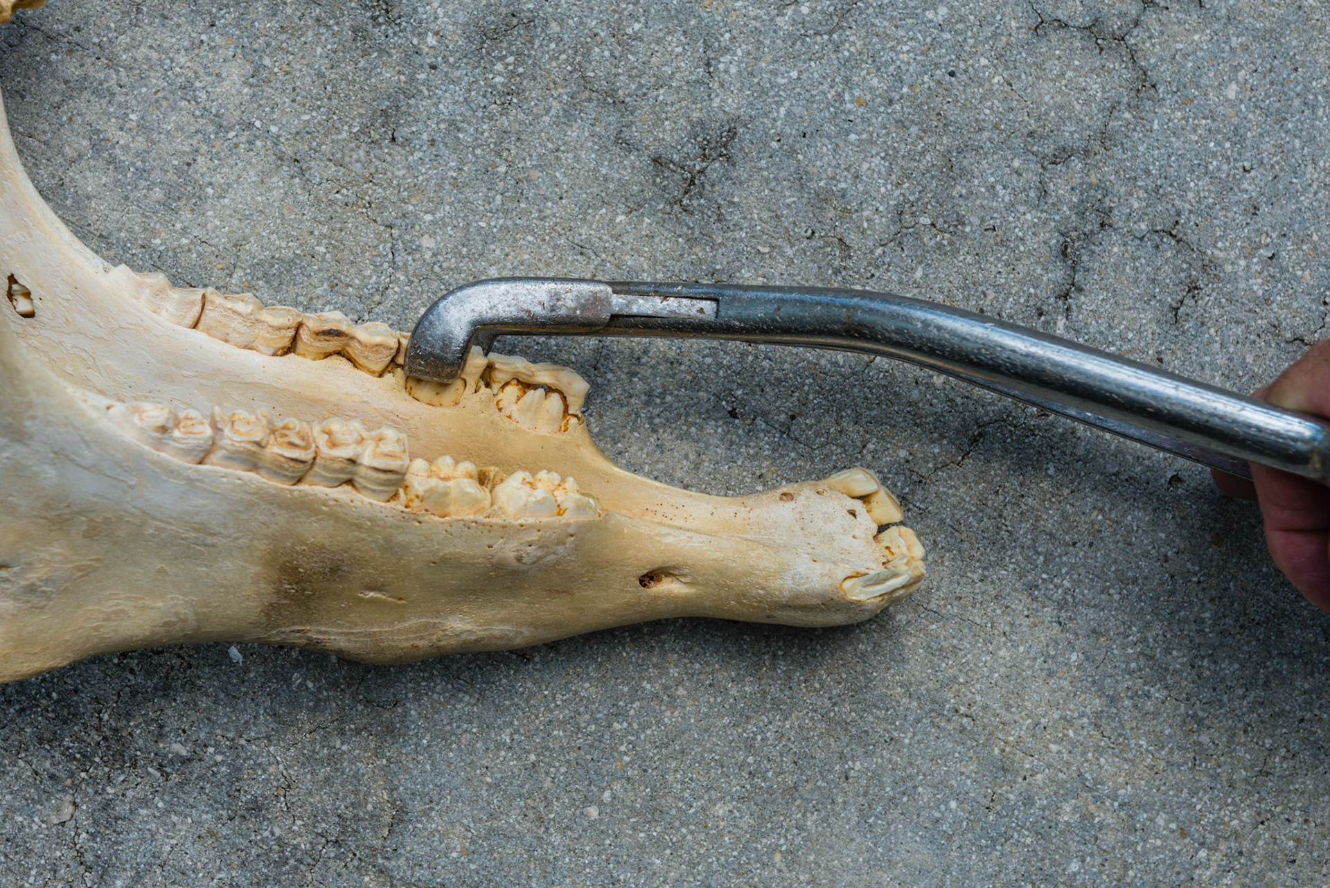 The cap forceps is caught on the lingual edge of 77 and will be rotated outwards to lift the cap off the permanent tooth.