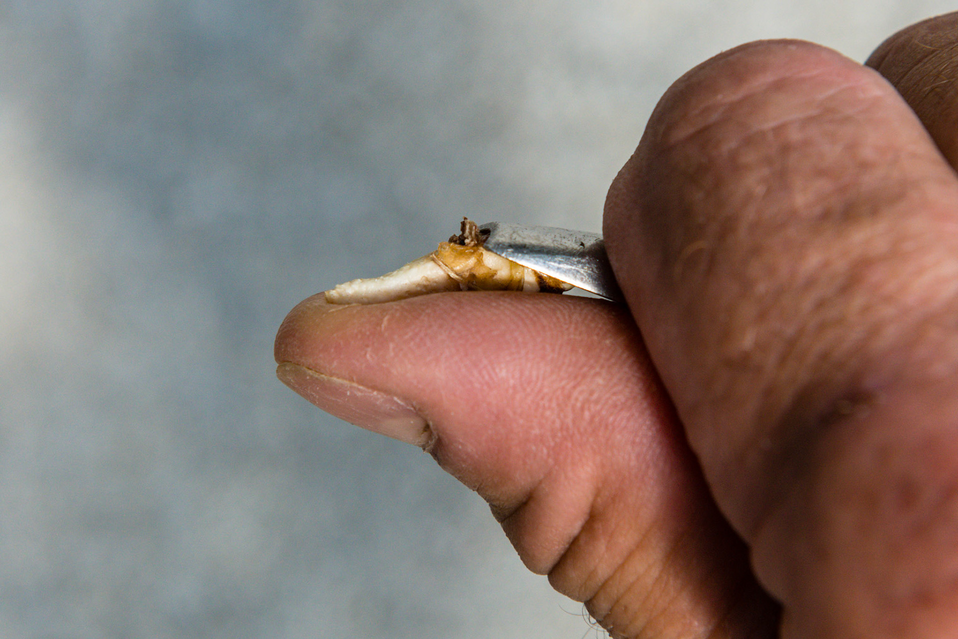 Use the flat wolf tooth elevator to help cut a tag of gum attached to the wolf tooth. In this position, the blade is driven down the tooth towards the root tip to sever the tag that is located at the flat elevator tip and attached to the tooth.  The thumb stabilizes the tooth against the cutting action of the blade.