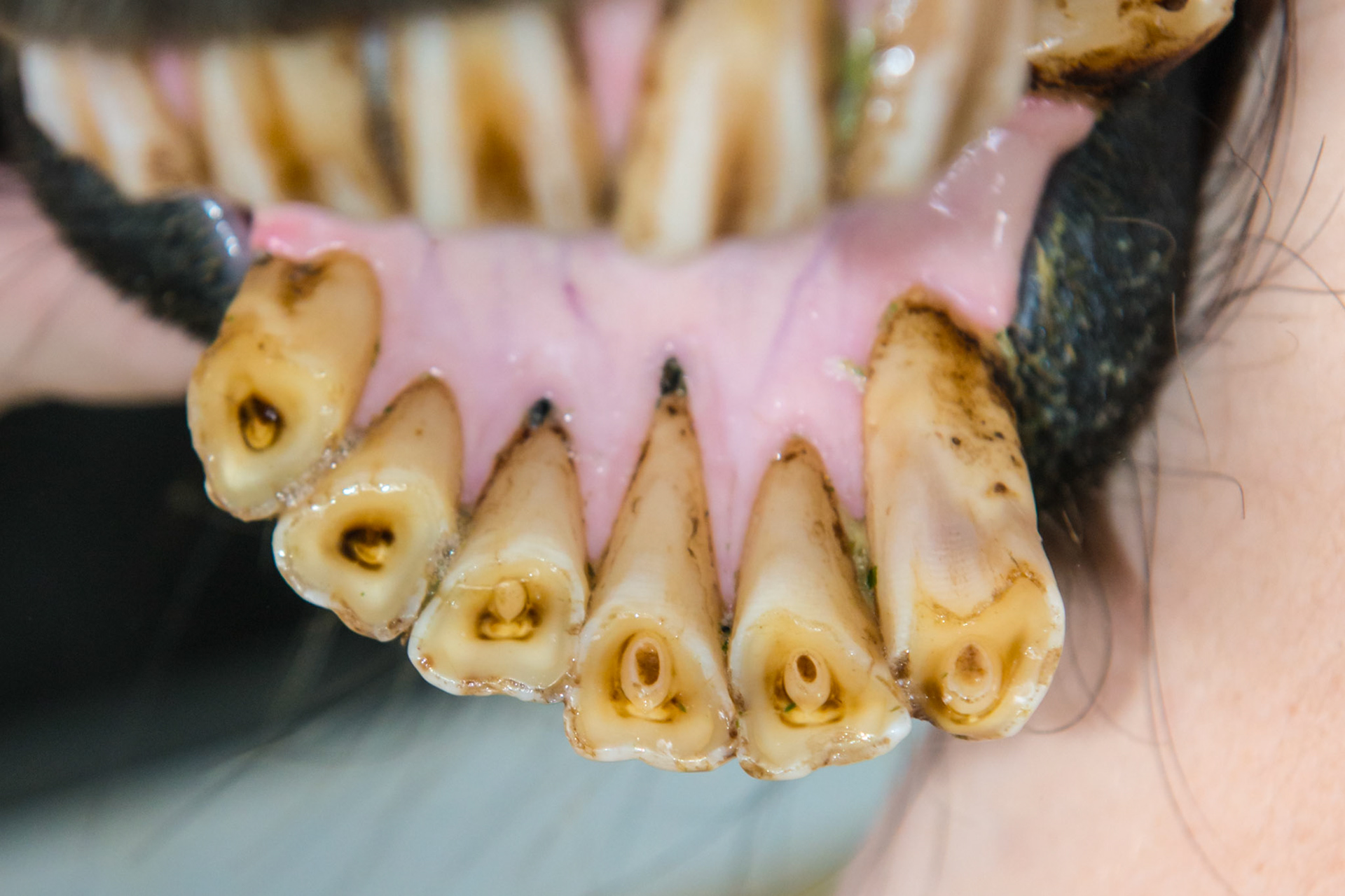 27yr 3mo - EOTRH and an underbite but only from the forward displacement of the lower left incisors. Note more receding gums on the lower left tongue side  and upper left lip side than on the right.