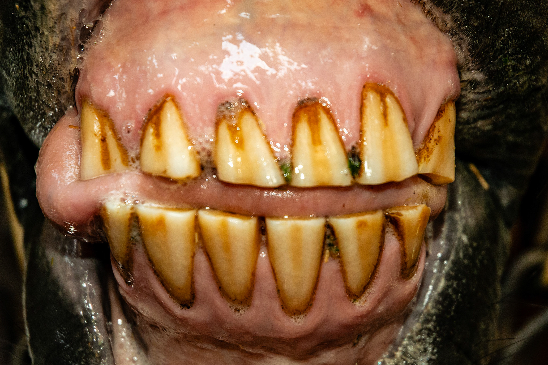 19yr 3mo - Bells palsy - tongue protrudes on right side and teeth are slightly out of alignment.