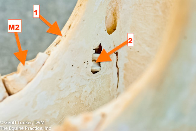HDS_Anno_Unerupted teeth