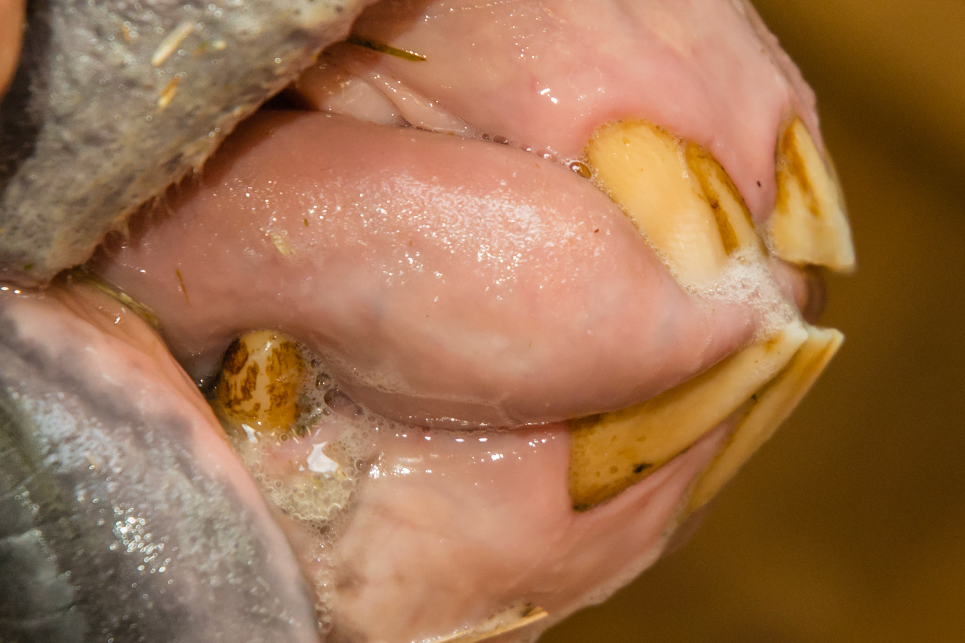 19yr 3mo - Bells palsy - tongue protrudes on right side and teeth are slightly out of alignment.