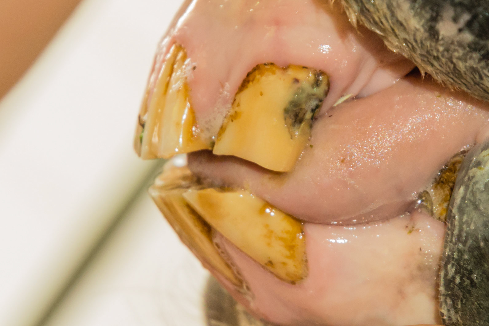 19yr 3mo - Bells palsy - tongue protrudes on right side and teeth are slightly out of alignment.