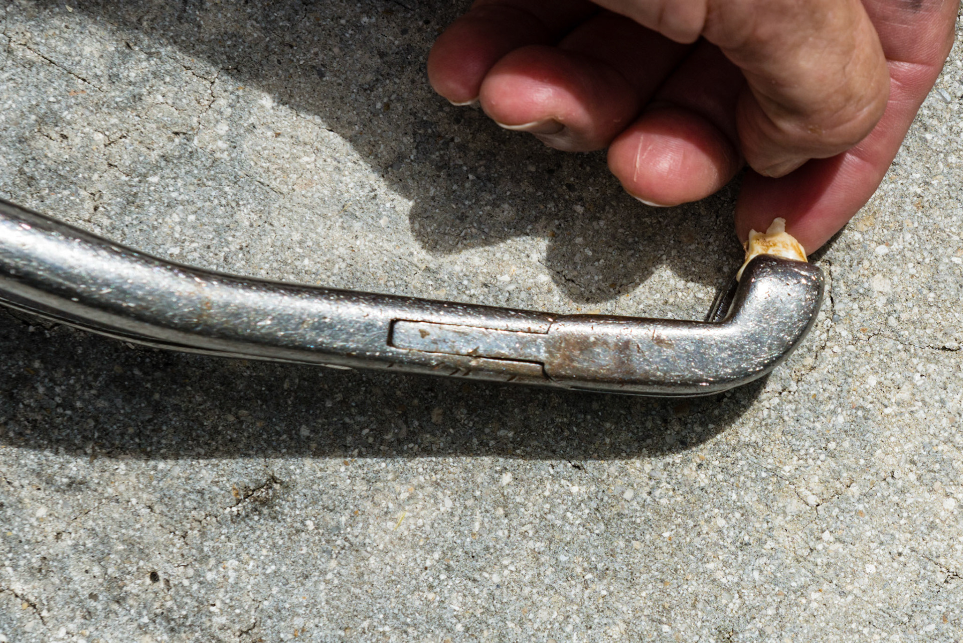 My finger represents the permanent incisor. The lower Reynolds cap forceps are placed on the incisor cap as seen here and the forceps are rotated outward rotating the cap away from the permanent underlying tooth.