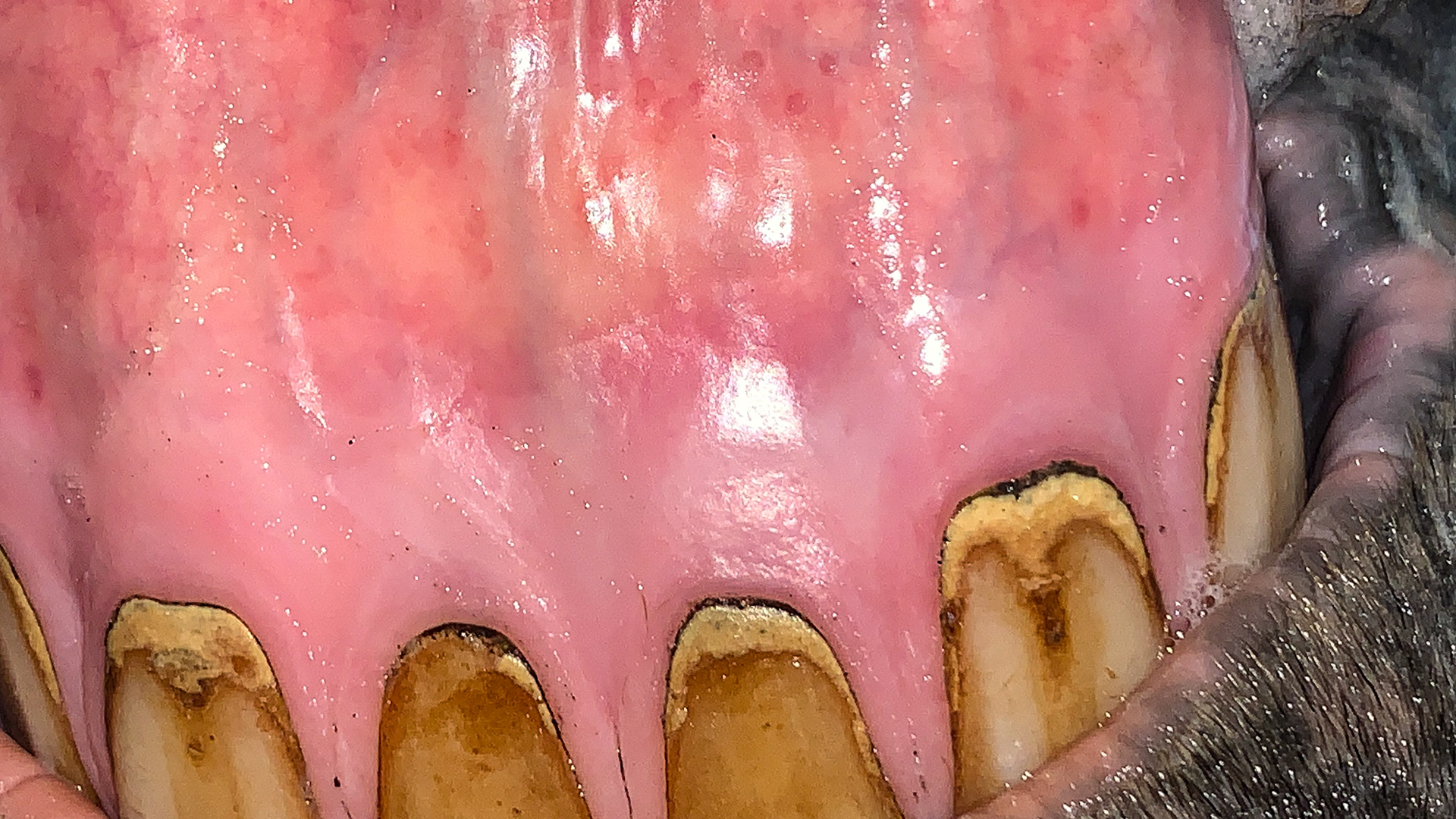 Incisor calculus with petechiae on the gums. This is an early sign of EOTRH.