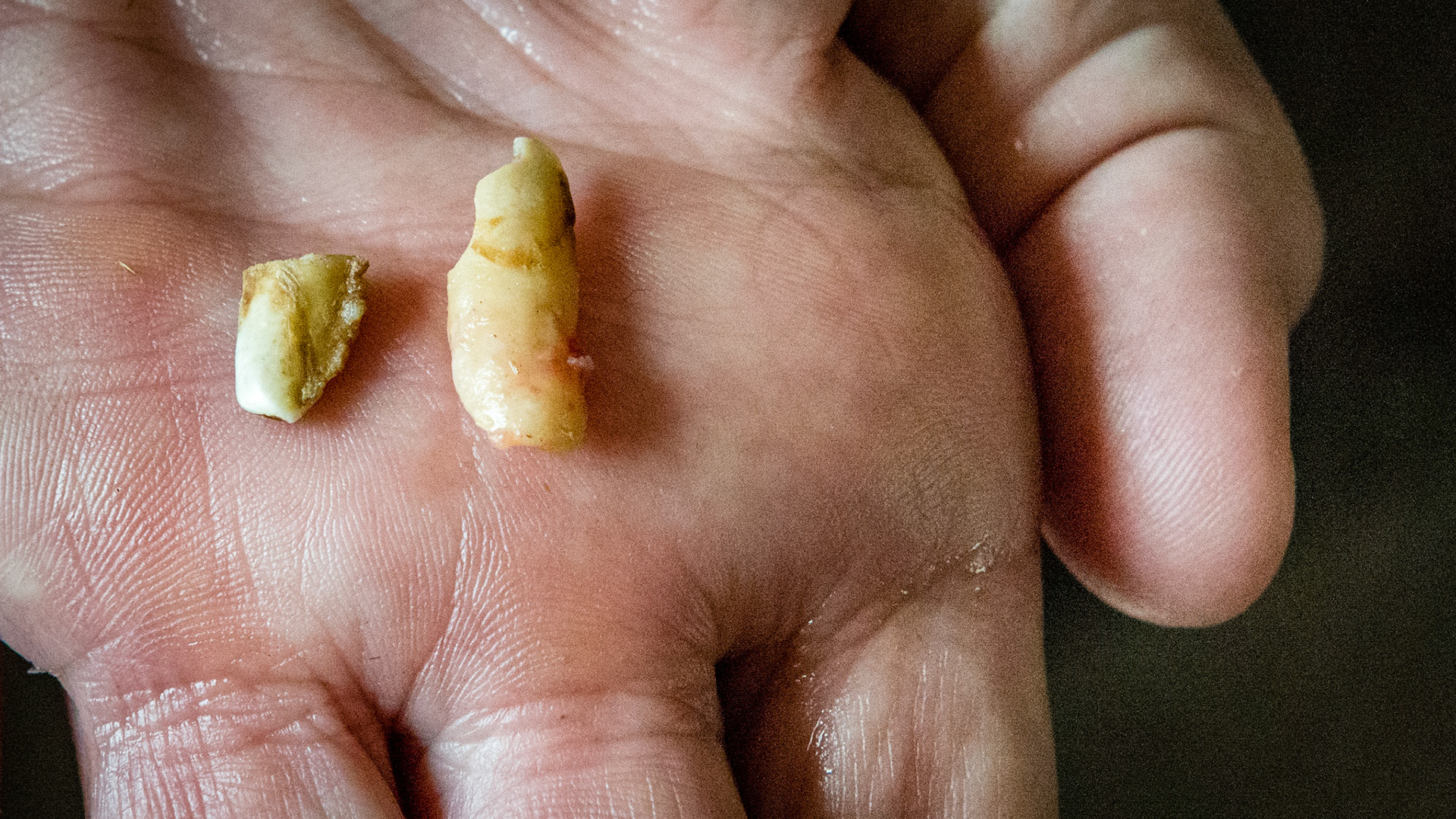 Incisor cap remnant horse 7 - 72 and 82 cap remnants in a 17 year old. Malodor but not painful. Removed without drugs using a wolf tooth elevator.