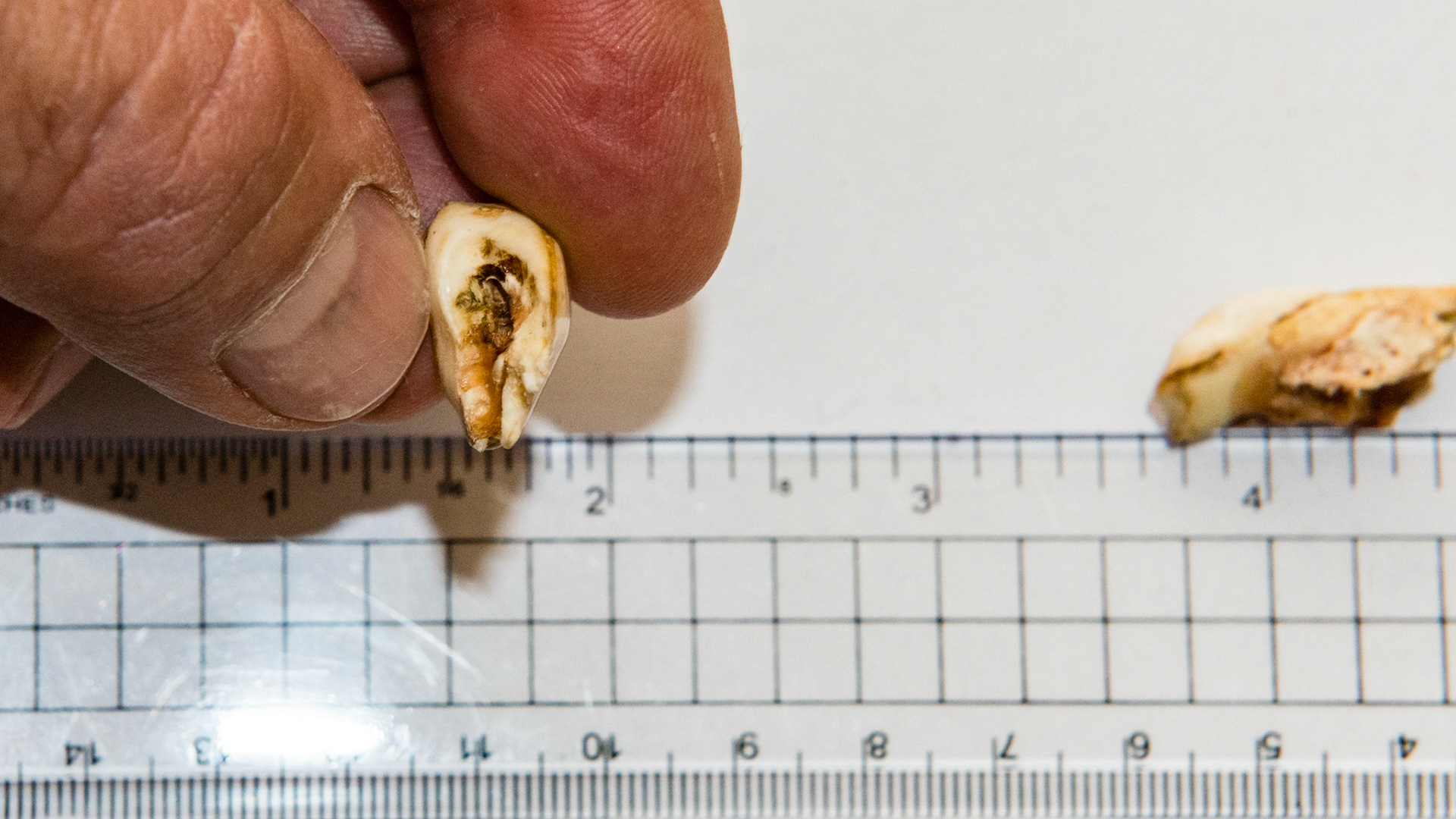 These incisor caps have excessive roots that look more like alveolar bone. Caps like these often remain attached displacing the underlying permanent incisor and requiring extraction by the dentist.