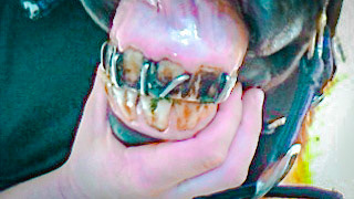 Horse A - Cribbing rings placed in between the incisors of this pony to prevent cribbing. This inhumane act often causes infection of the underlying bone.