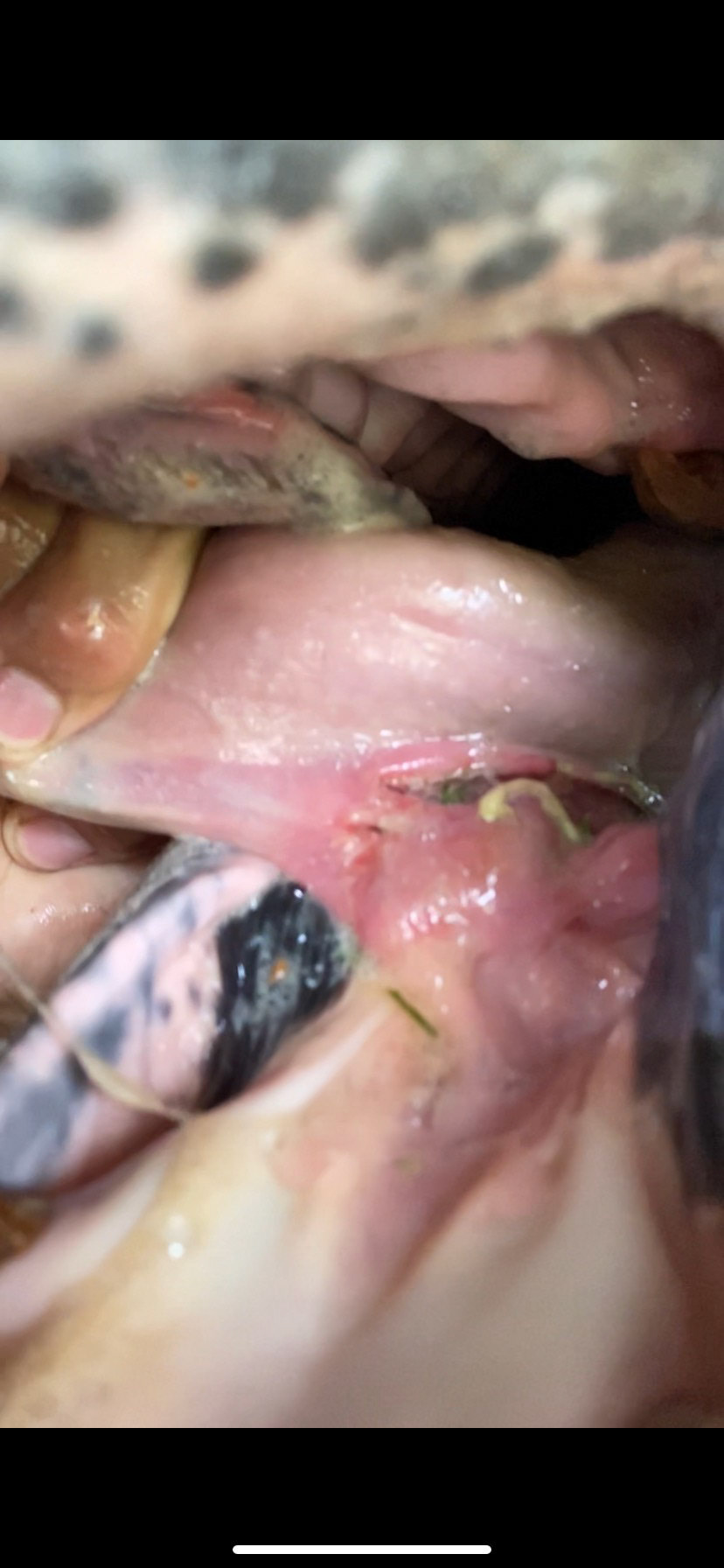 Tongue frenulum damage from power dentistry. About 3 days after.