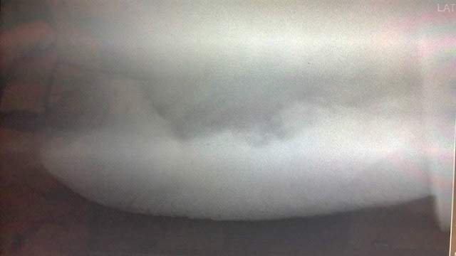 Radiographs showing sand in the colon.