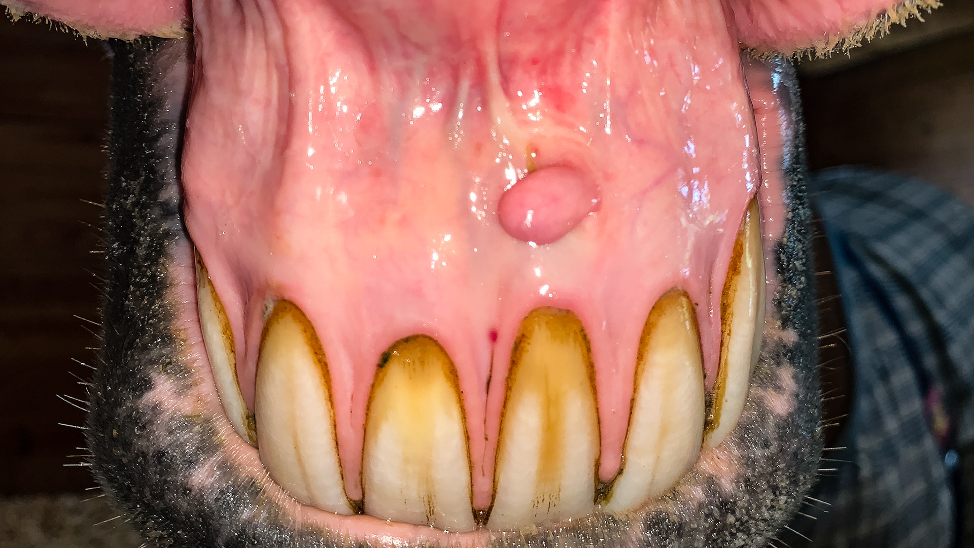 A soft non-painful growth on the gums. Most likely there since birth.  Note the receding gums with a slight gum line hypertrophy.