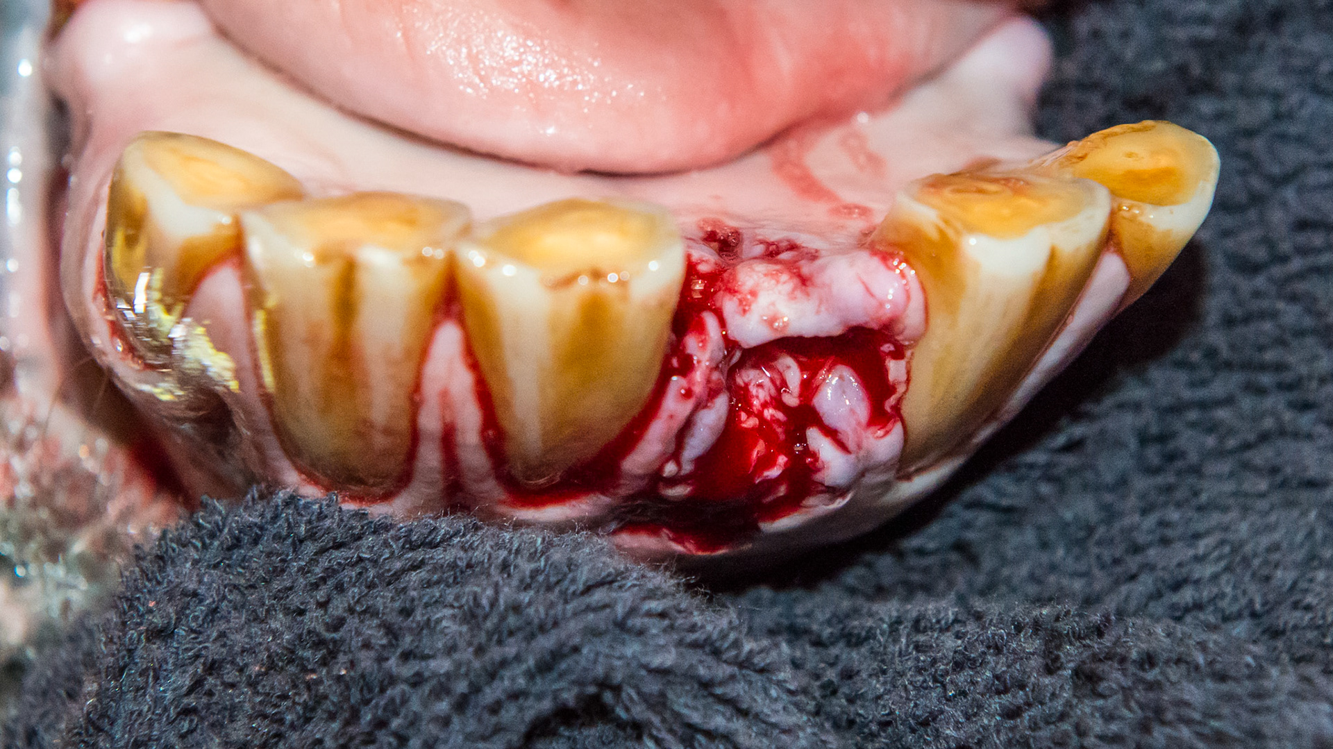 EOTRH horse 17 - #301 coronal fracture due to EOTRH with tooth fragments remaining. The socket cleaned of all palpable pieces of incisor.