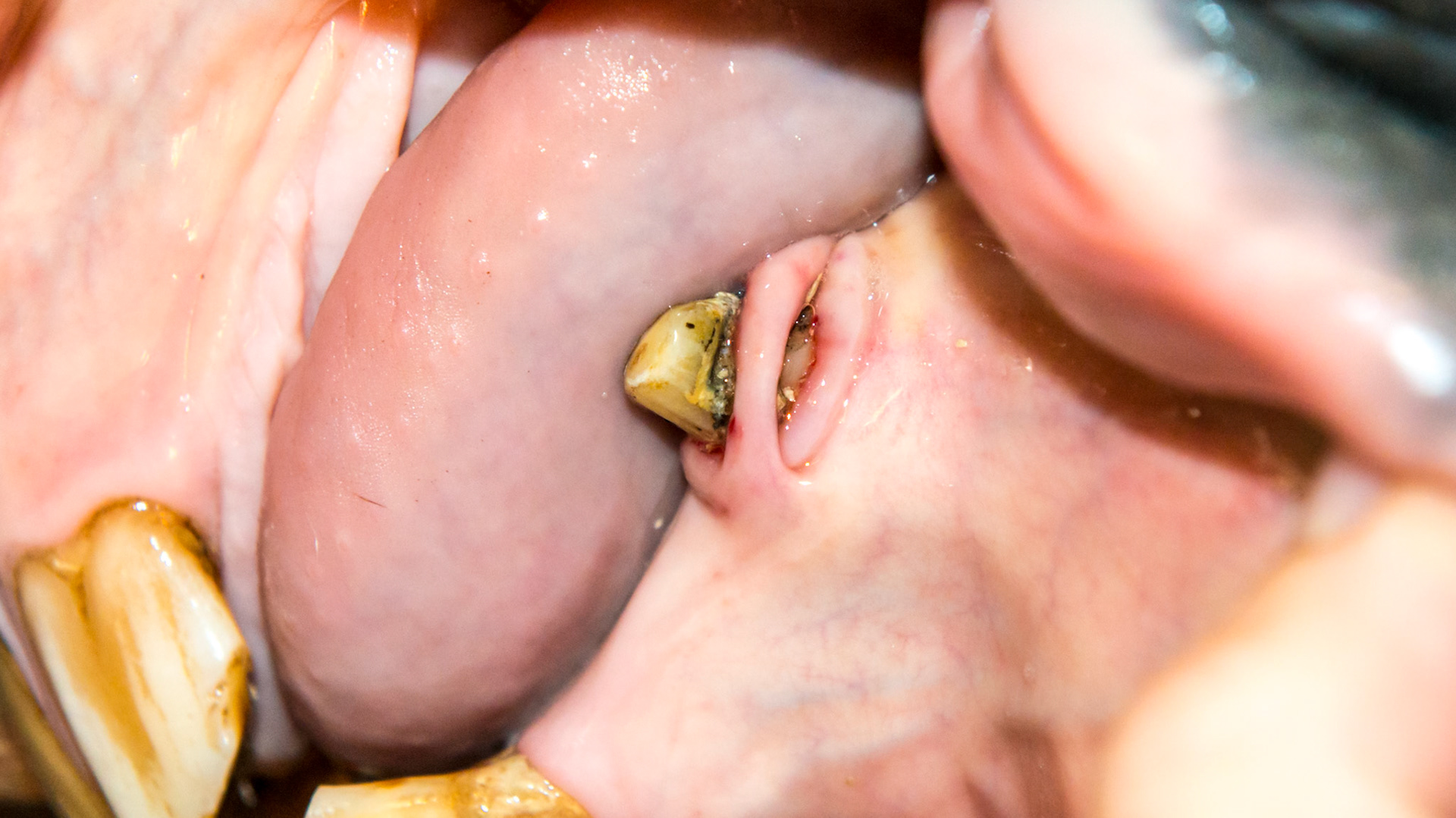 A band of gingiva courses on the lateral side of 304 canine with calculus forming only on the buccal side of the canine. Here the calculus has been removed.