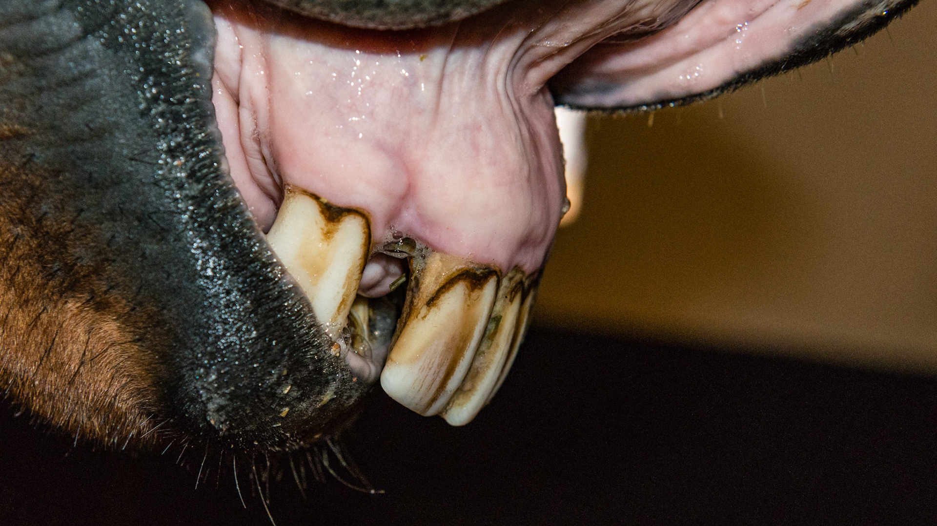 Avulsion fracture of the maxilla displacing the central upper incisors (101, 102, 201, 202). This fracture was allowed to heal without reduction into a normal position.  Age is unknown.