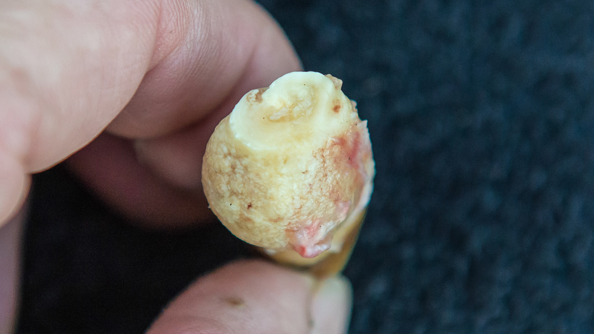 EOTRH horse 18 - 20 yr old Bay QH-Paint G #303 loose and painful. Proliferation of cementum with cobblestone surface and slight gum attachment holding the tooth in the mouth. The crown is between my fingers. This tooth was easily extracted using finger pressure with IV analgesia.