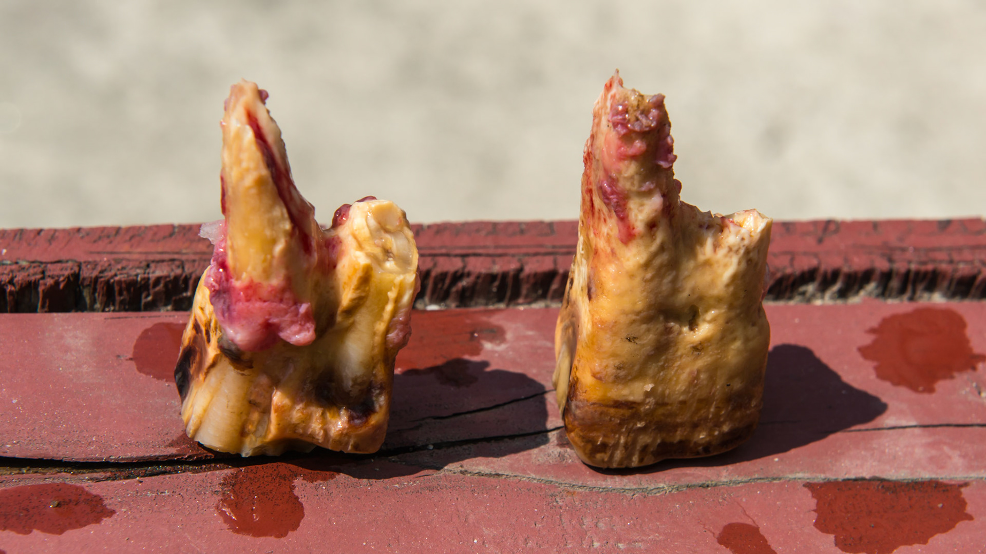 308 and 408 in a 22 year old mare.  These teeth tilted laterally into the cheeks with packed hay.  The tongue was unable to clean the areas.  There was a malodor of decay in both teeth and both were loose and painful.  Extractions were simple with IV pain medication.  Both teeth had broken roots that had fractured in the past.  The remaining roots were left where they were and the horse was given 3 days of Uniprim.