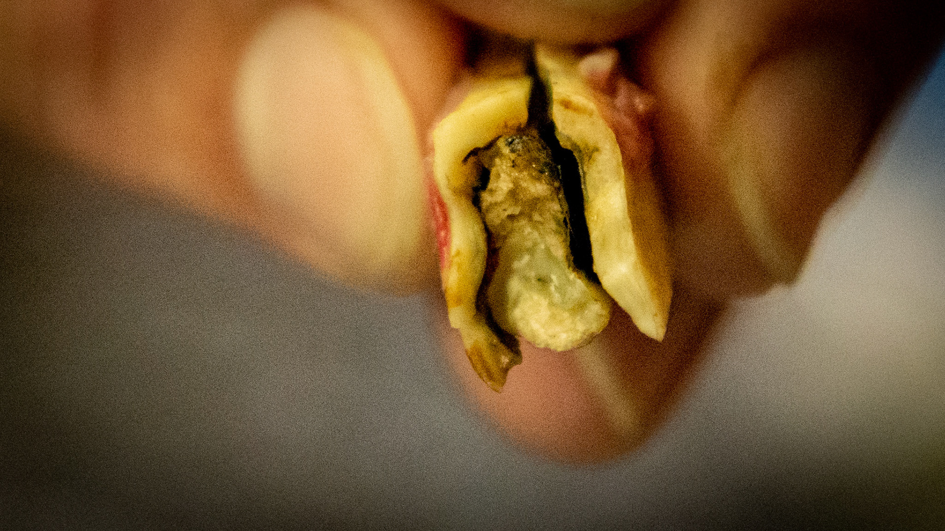 Horse B - Decay in #401 incisor had split this tooth into 3 pieces with the outside pieces broken off of the remaining tooth which remains in the horse. This is the distal end of the tooth.