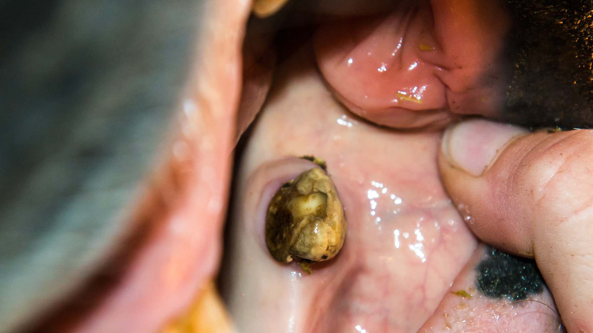 A band of gingiva courses on the lateral side of 304 canine with calculus forming only on the buccal side of the canine.
