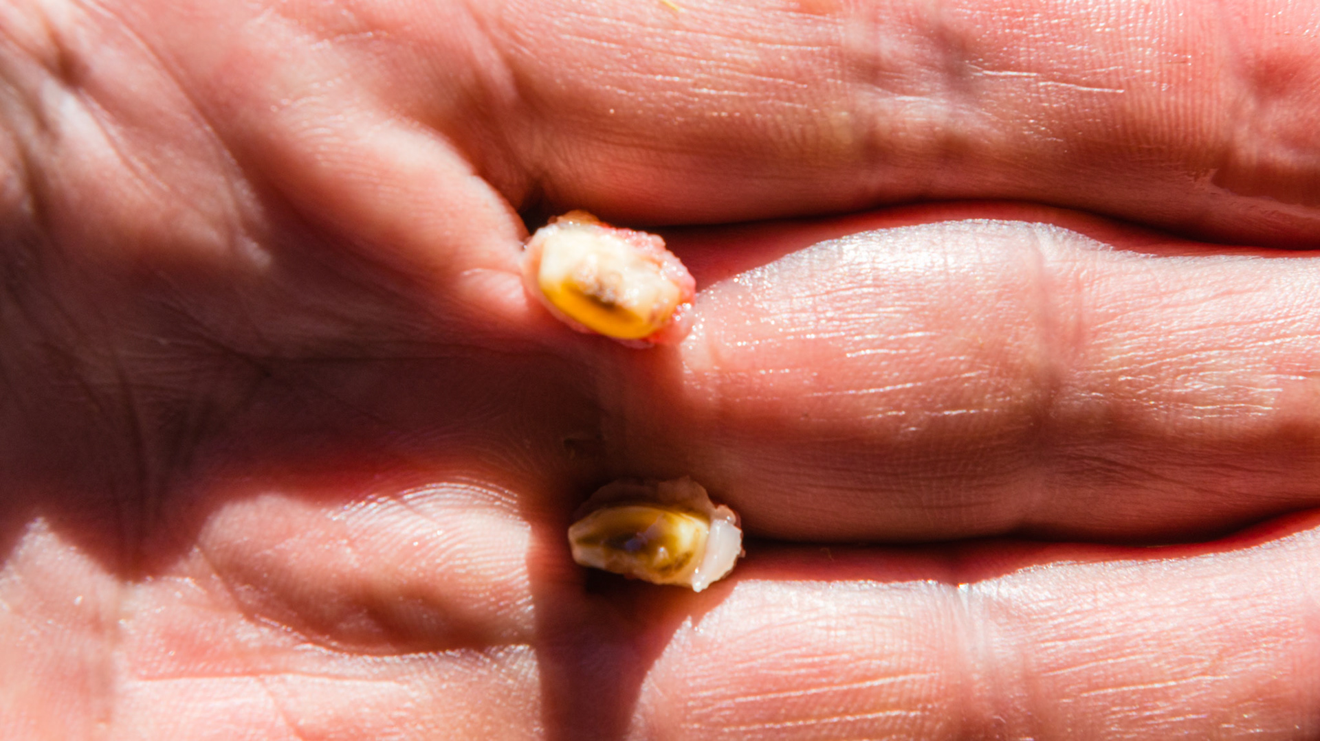 Wolf teeth 105 and 205 set towards the inside of the 6's in a 3 yr old Mustang. Difficult to start. Needed to keep mouth open with one hand and insert the elevator from the inside of the mouth and angled from medial to lateral to catch the edge. Then they came out with just a little struggle. Distal end.