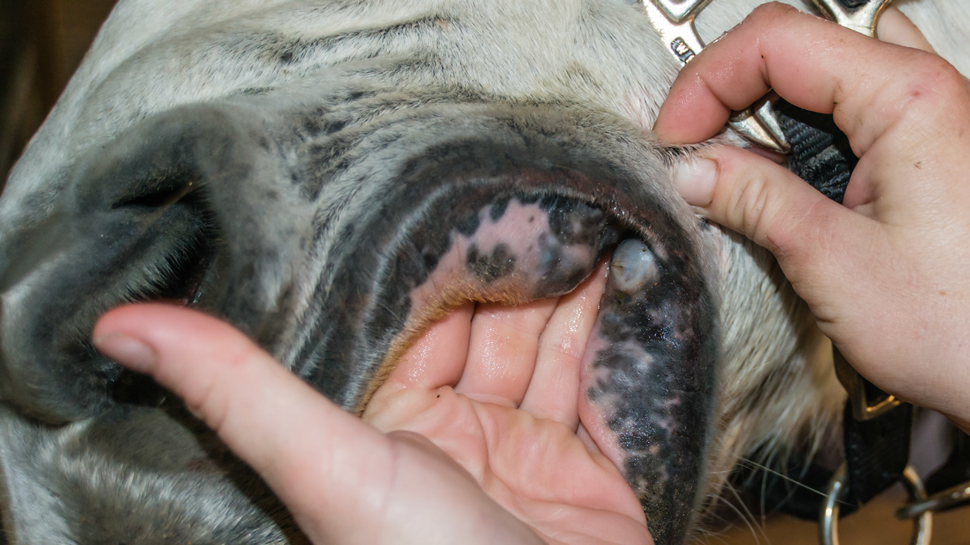 Melanoma in a 25 yr old. Large melanomas at the corners of the lips.