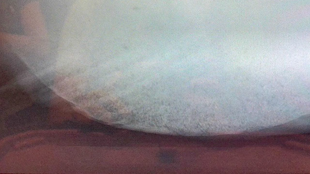 Radiographs showing sand in the colon.