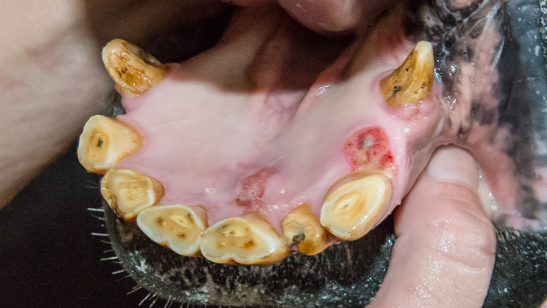 Partially healed erosions with a healing edge but still being aggravated from the tongue.