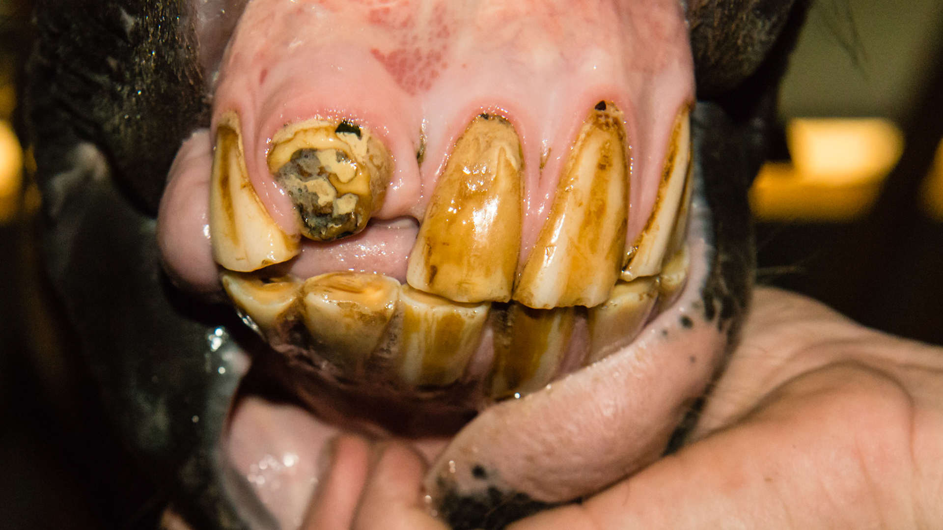 18 yr old with old trauma - missing 101, broken 102, and lip neuro deficit and #402 slightly over-erupted with tongue ware on front edge.