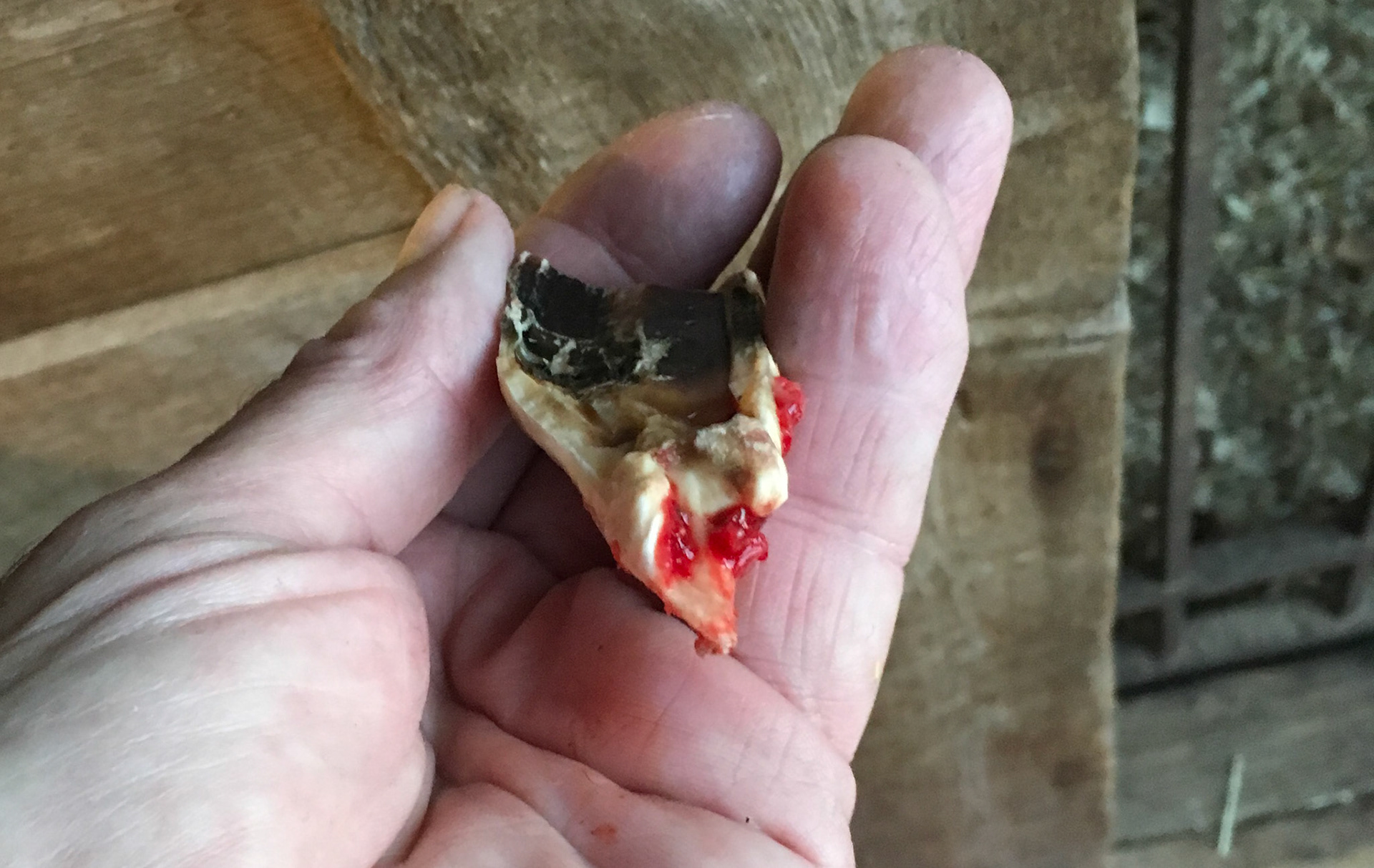 Large cheek tooth fracture shows the black decay that caused the saggital split.