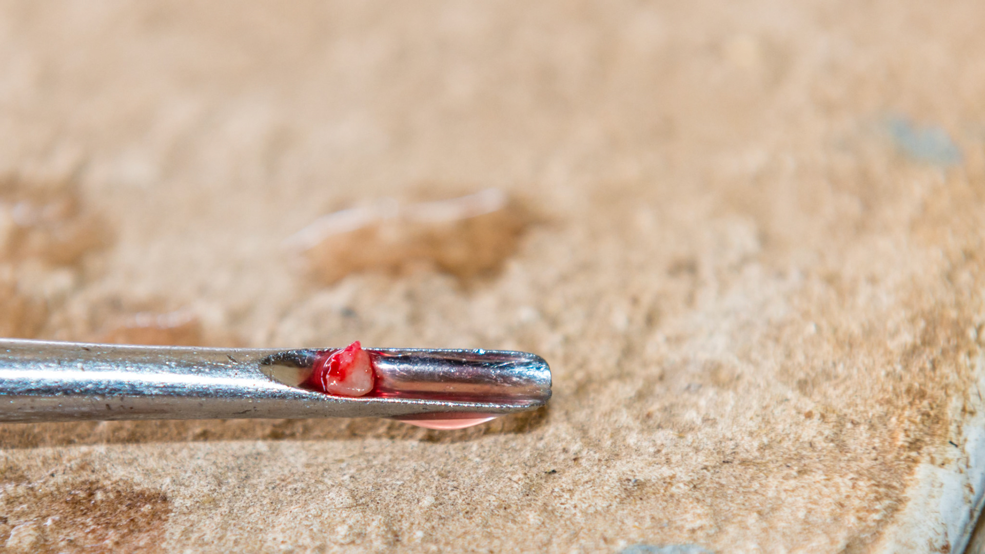 A tooth fragment rostral to 304 with gum irritation. Fragment on the elevator.