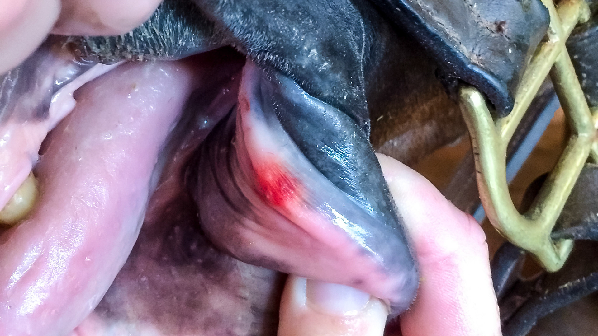 Bruising of the lower lip.