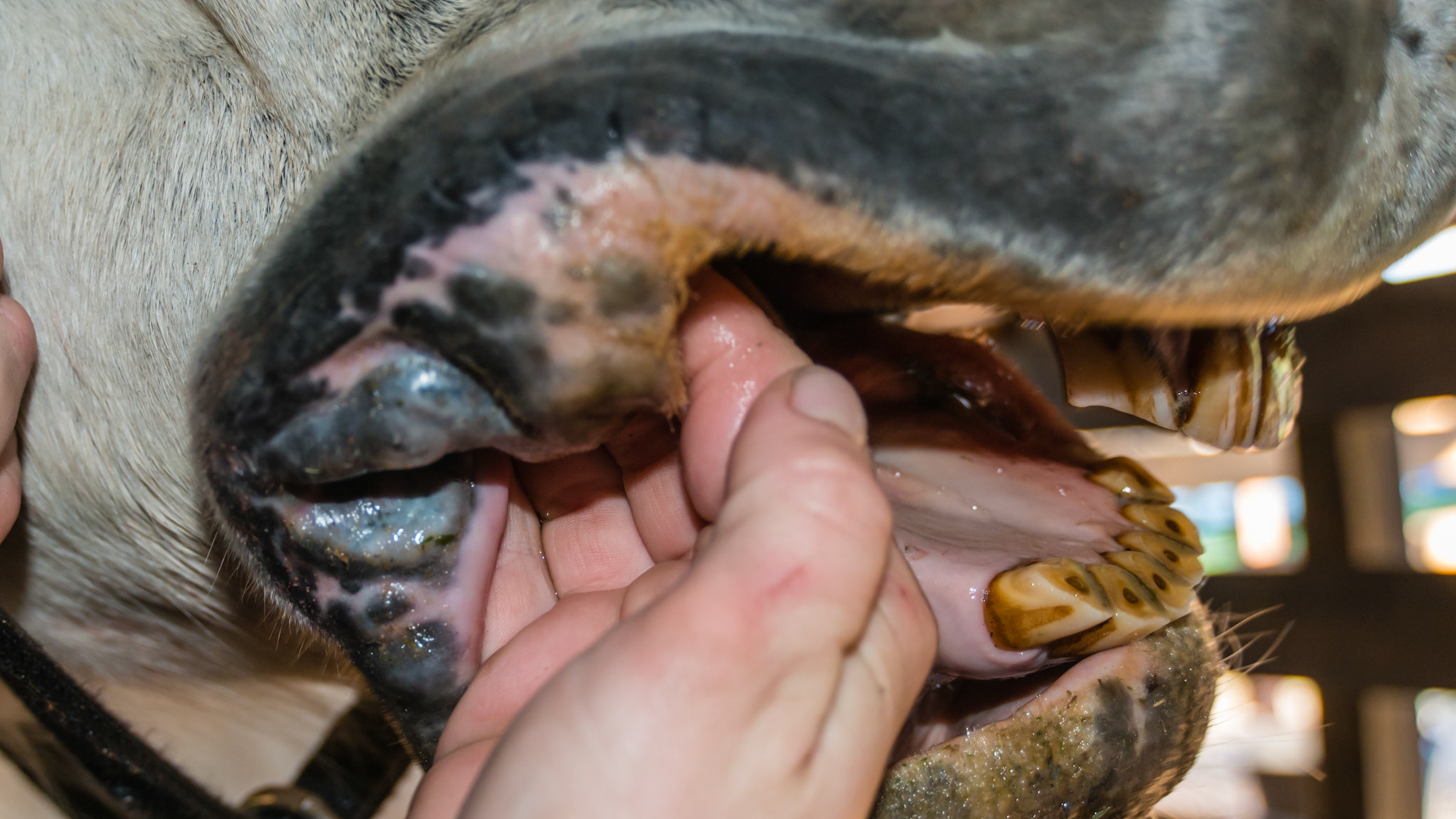 Melanoma in a 25 yr old. Large melanomas at the corners of the lips.