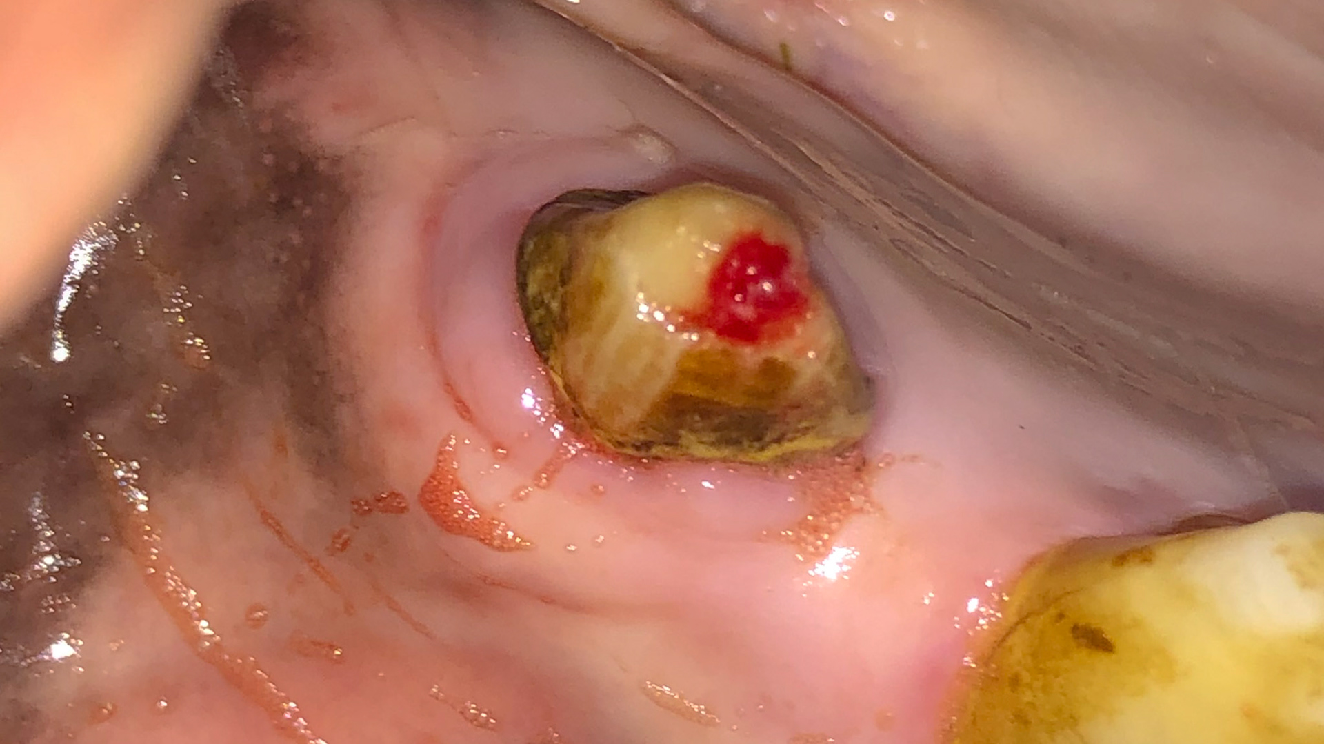 Broken canine as an incidental finding