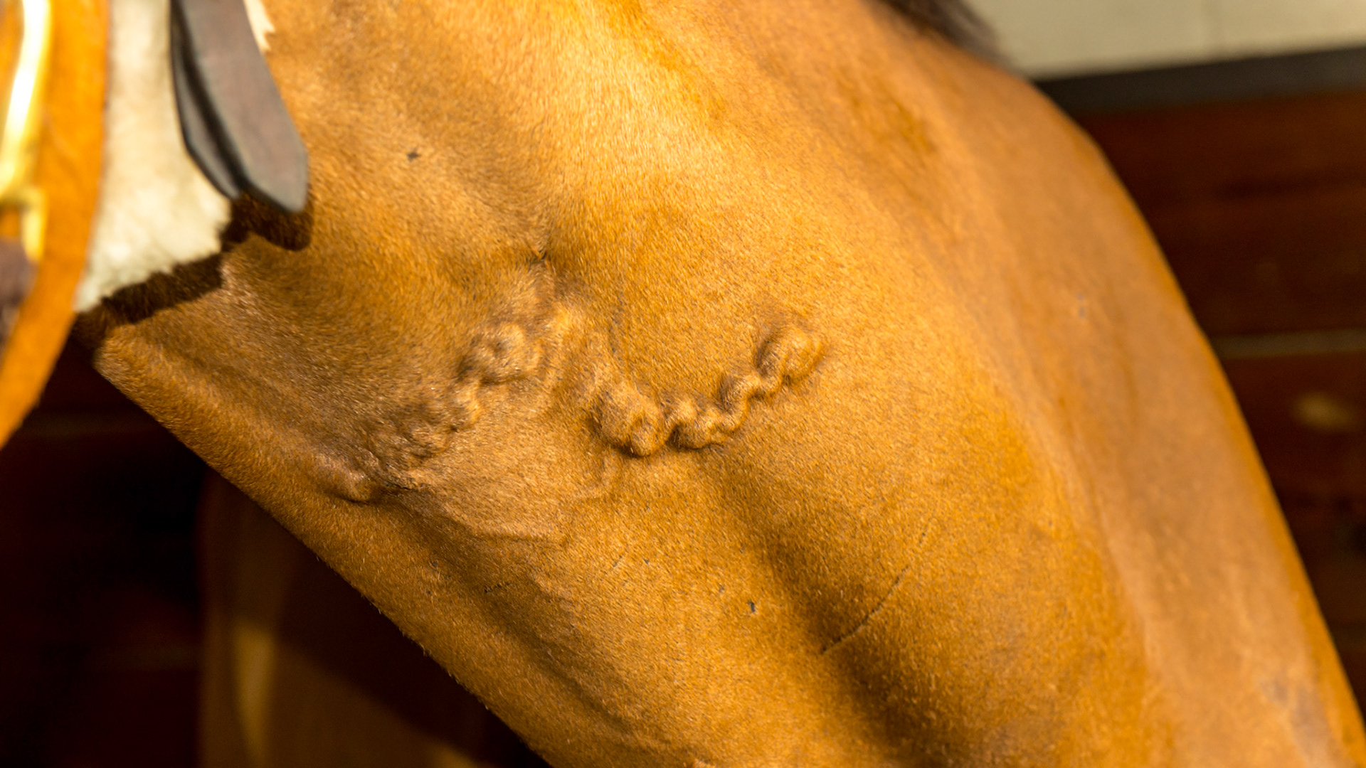 A filled vein from a thrombosis (occluding blood clot) from an unknown cause.