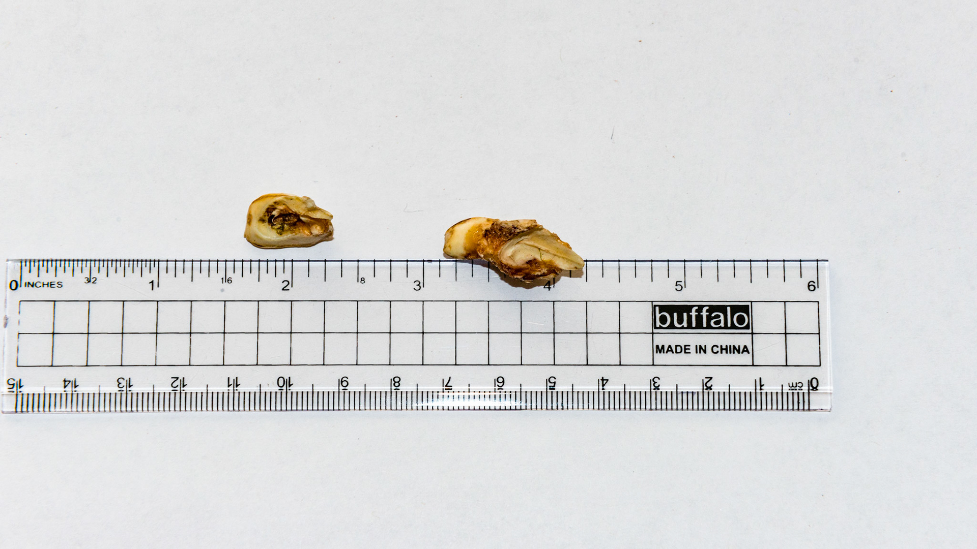 These incisor caps have excessive roots that look more like alveolar bone. Caps like these often remain attached displacing the underlying permanent incisor and requiring extraction by the dentist.