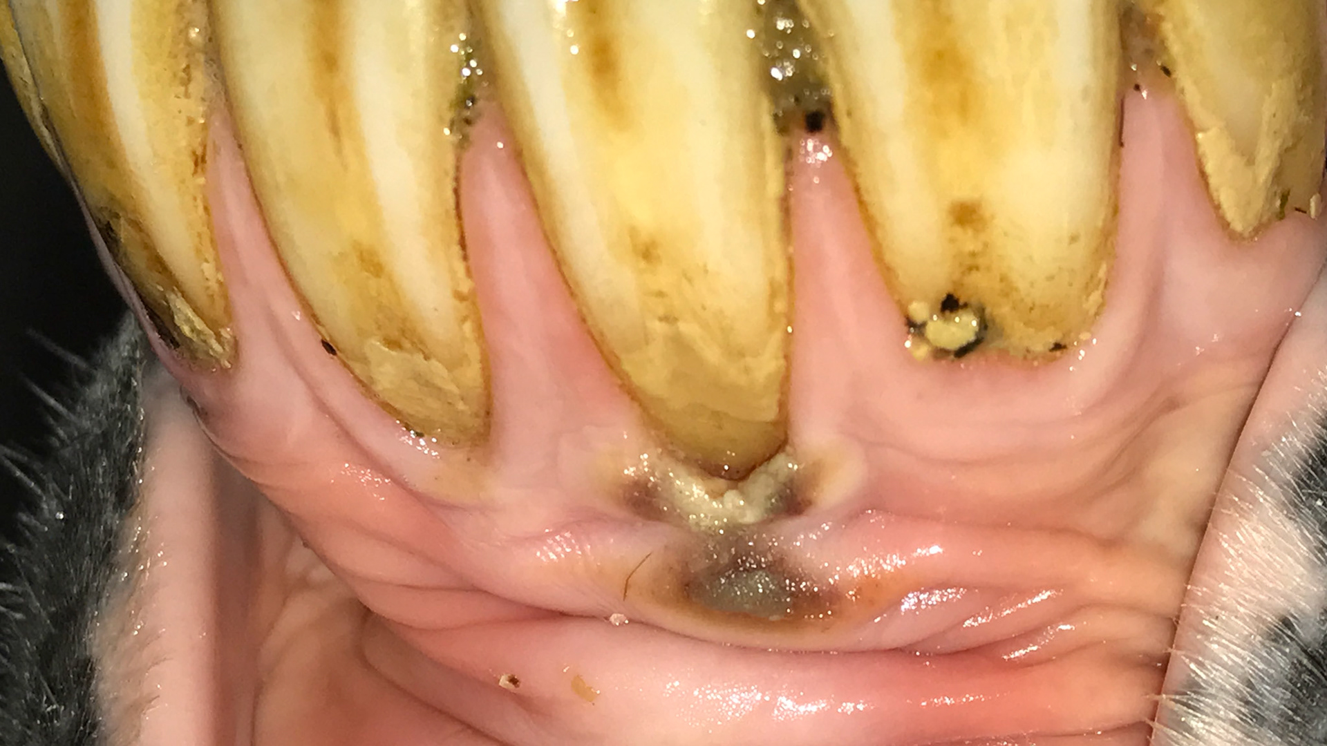 Decay near the root at the gum line of 301 incisor with receding gums, thickening gum lines.